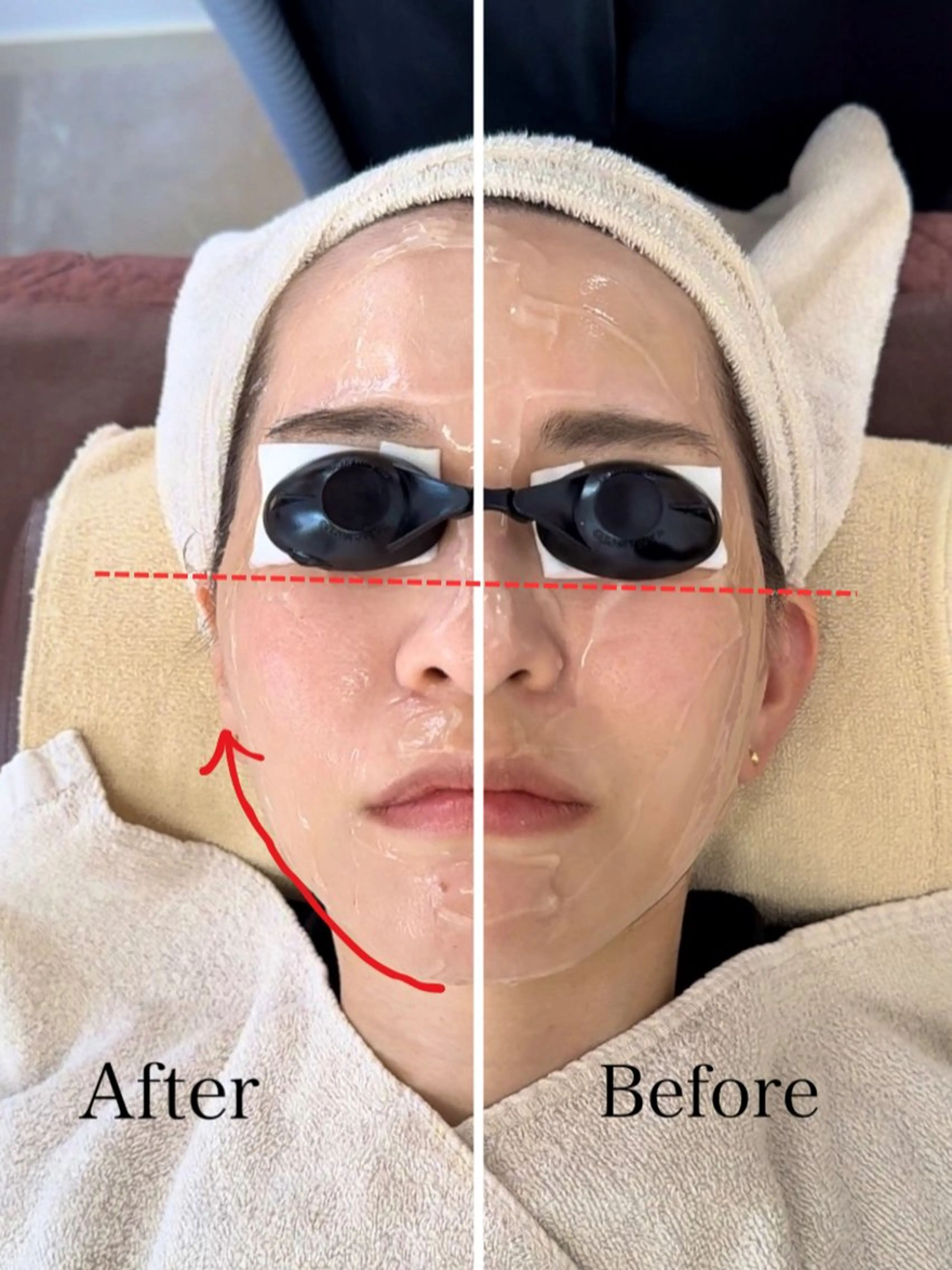 【光フェイシャル】お肌のハリ/リフトアップ/毛穴引き締め/シミ/ニキビ/くすみ/赤み/肌の色むらの写真