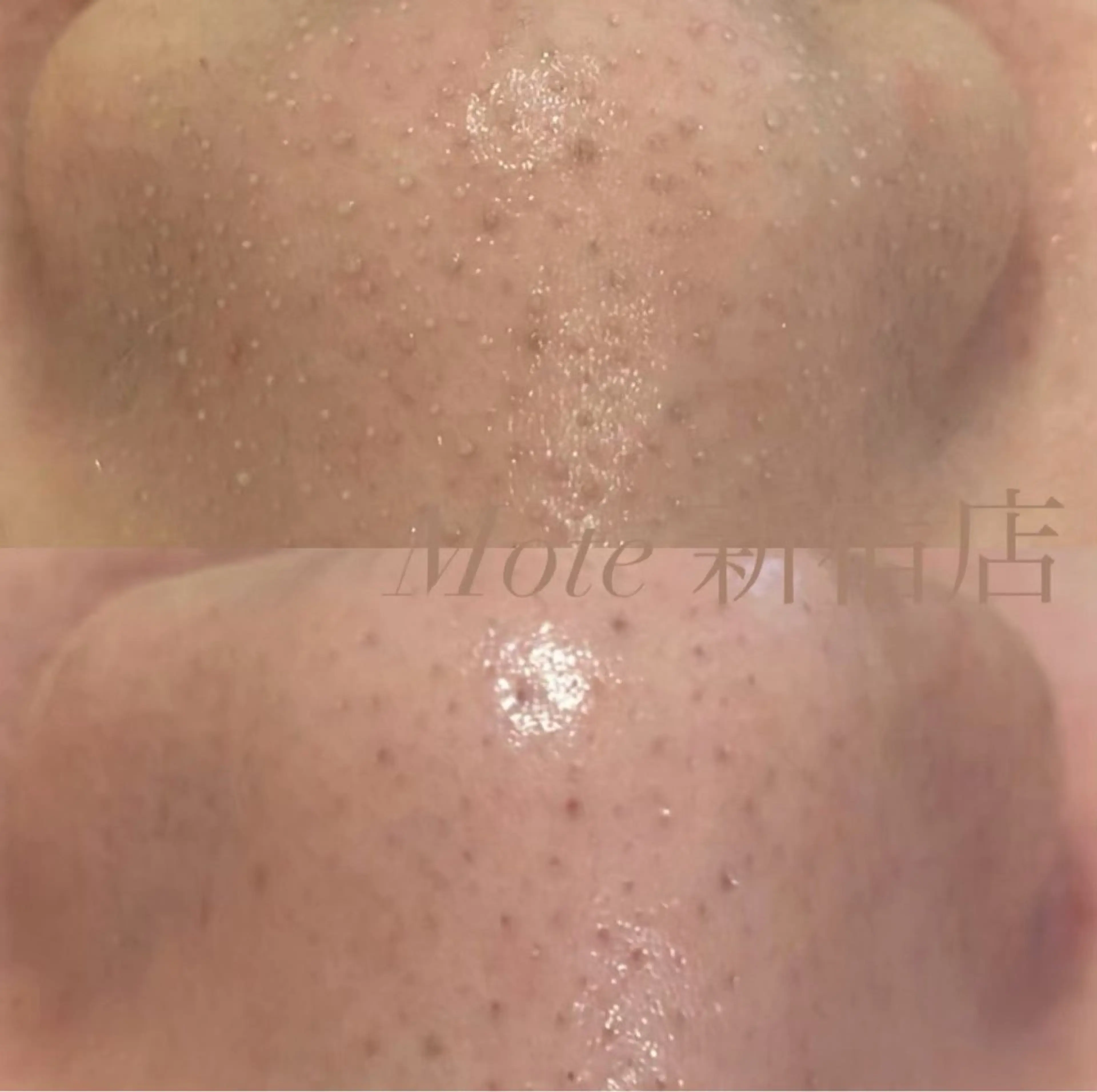 【美容液で洗う】全顔ハイドラ毛穴洗浄+ヒト幹導入の写真