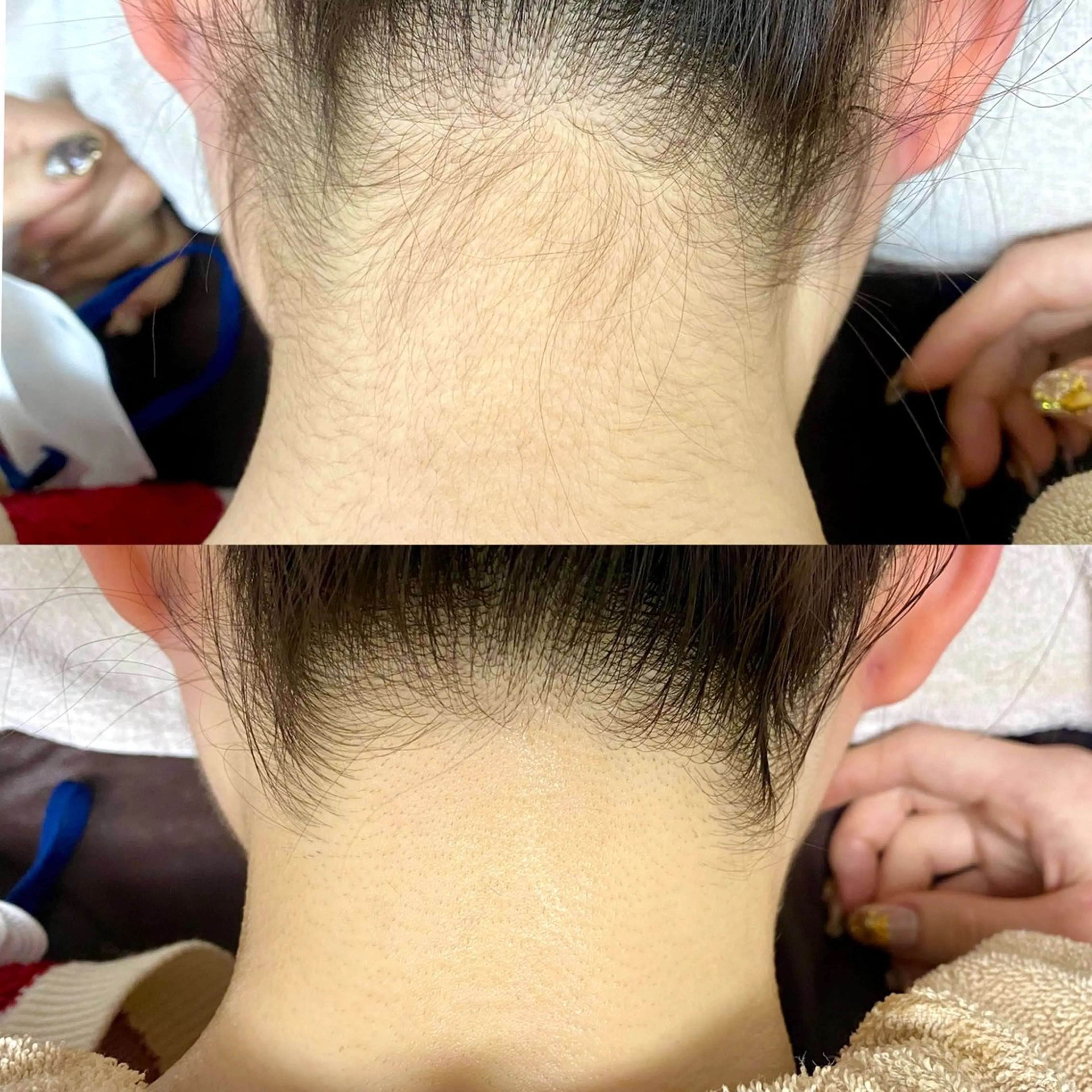 【えりあし脱毛】何度でも利用OKの写真