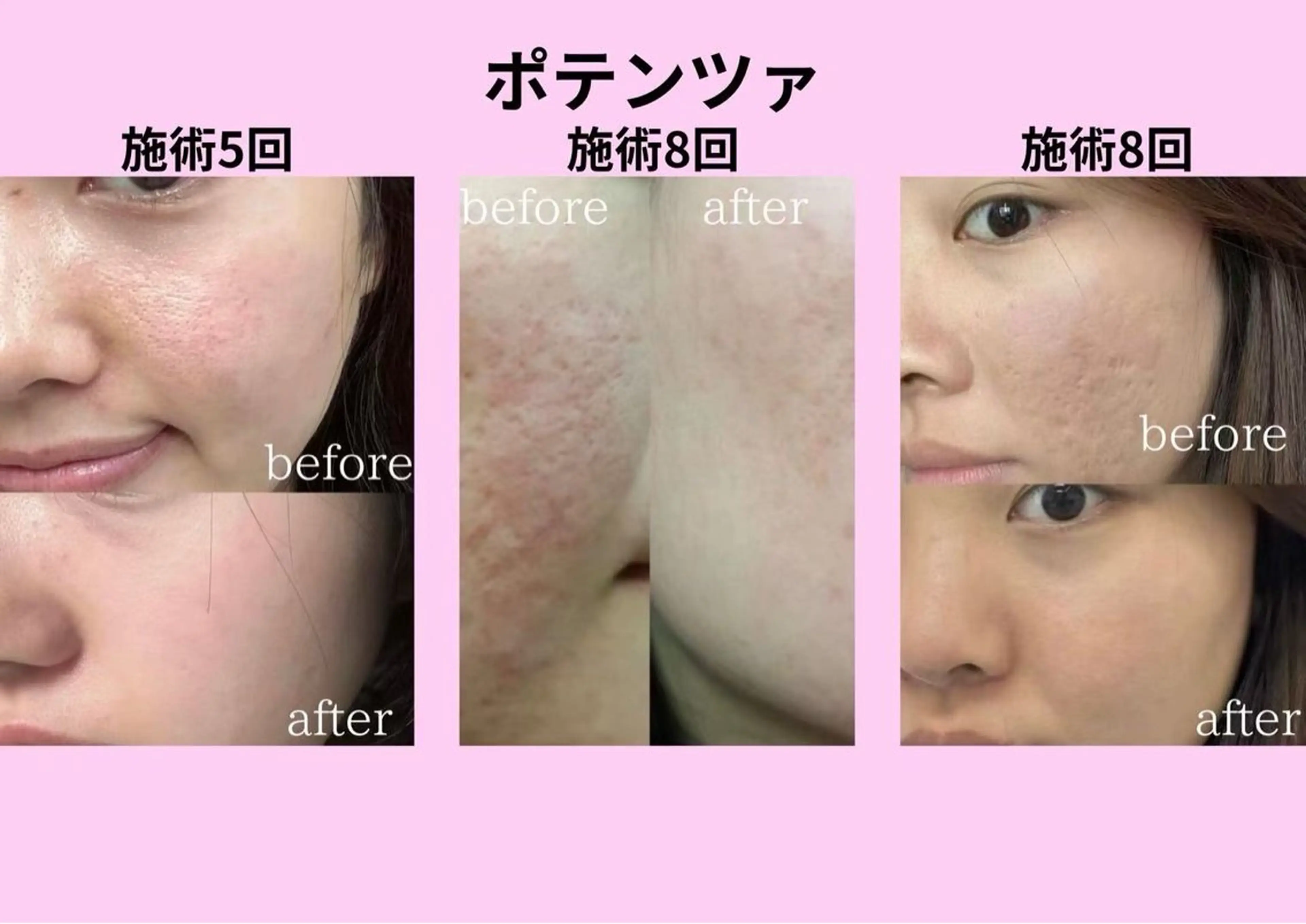 マツエク・マツパ エステ aliaハイフ&水光ジェットサロン所属・aliaハーブ水光店 エステティシャン募集のエステ・リラクイメージ