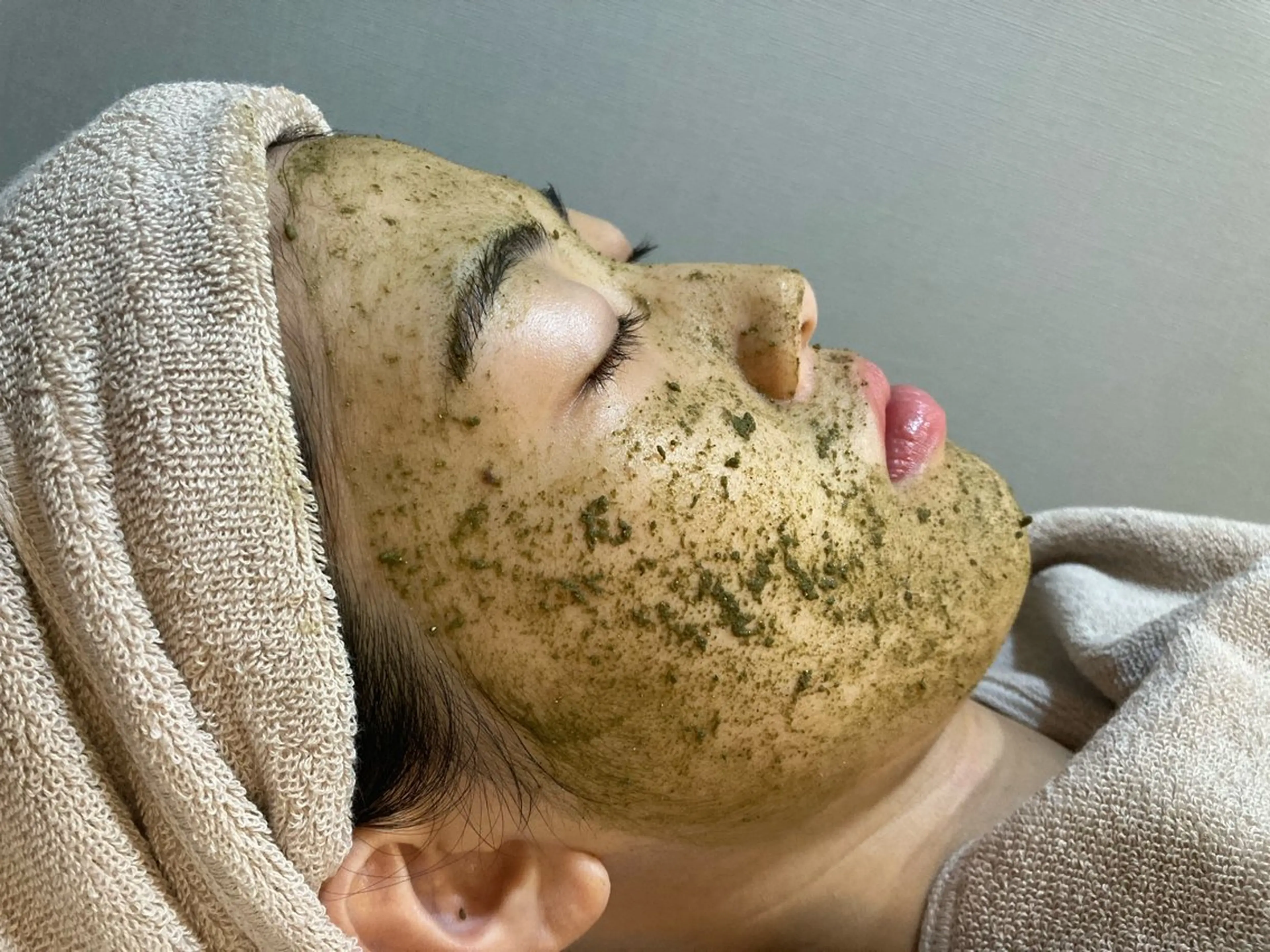 【大人ニキビに😮💨】ハーブリプロ ハーブピーリング(剥離あり)の写真