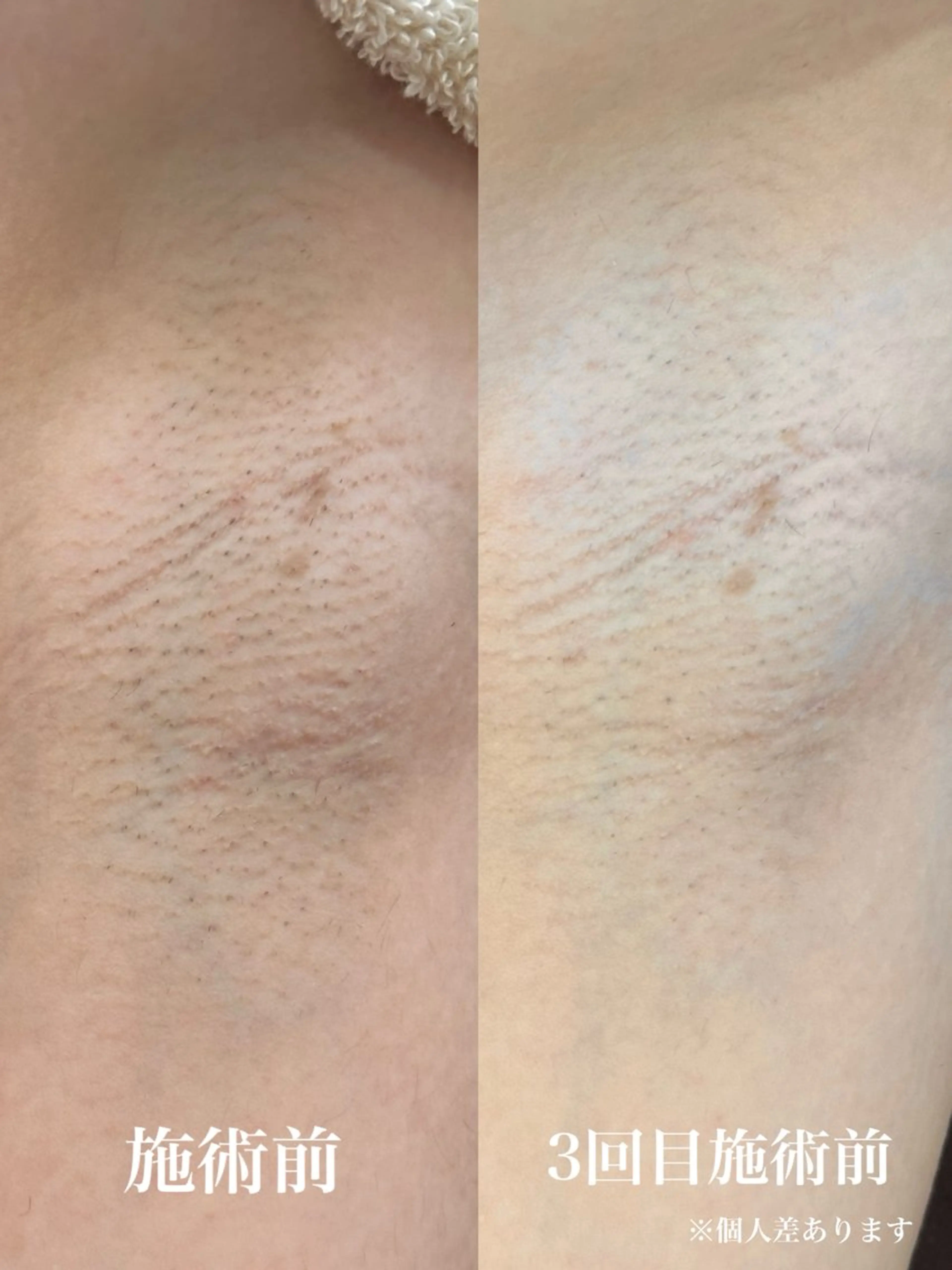 レディースワキ脱毛の写真