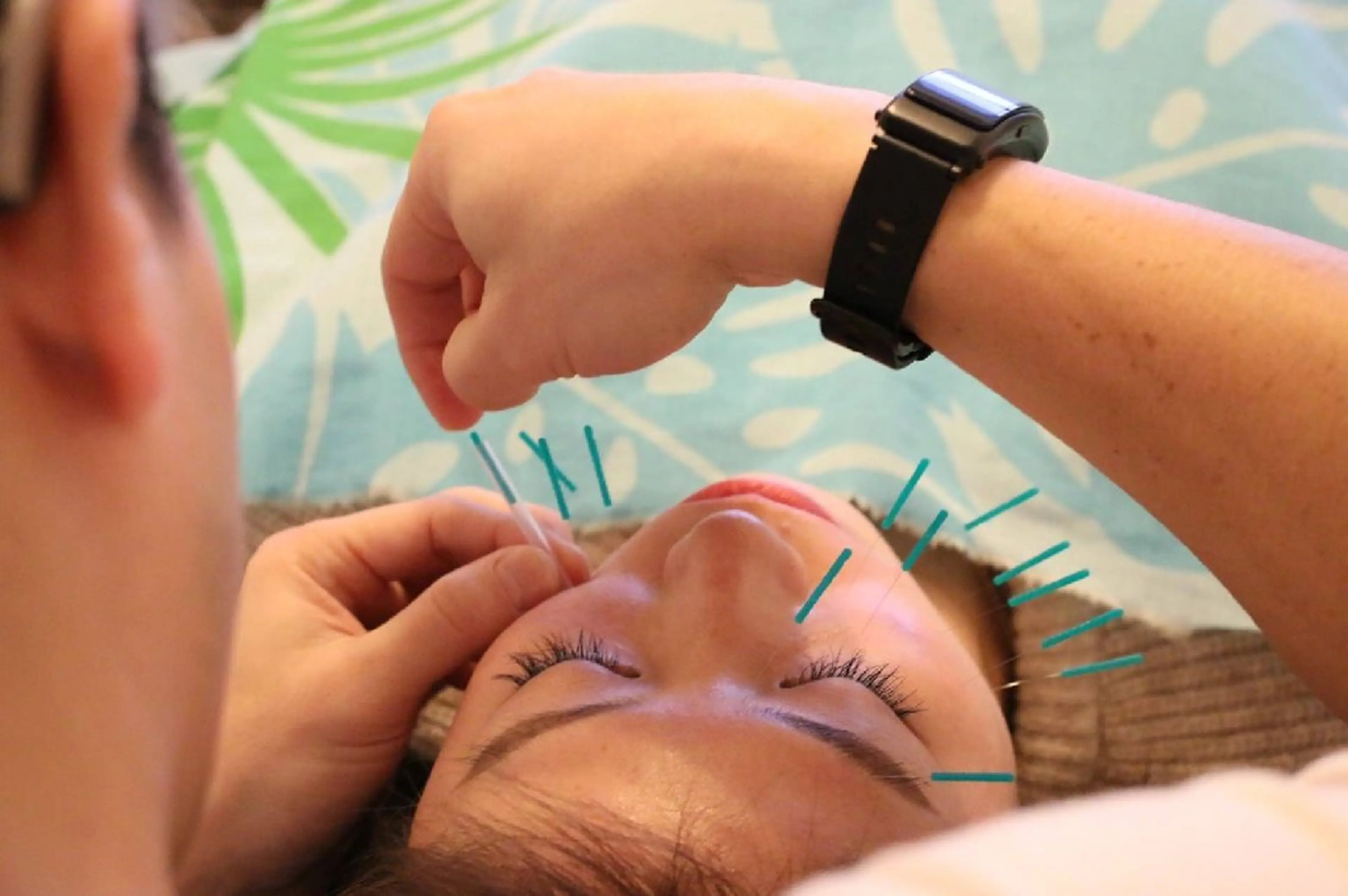 2️⃣美容鍼&美整顔矯正&ヘッドスパ🌟人気No.1🌟の写真