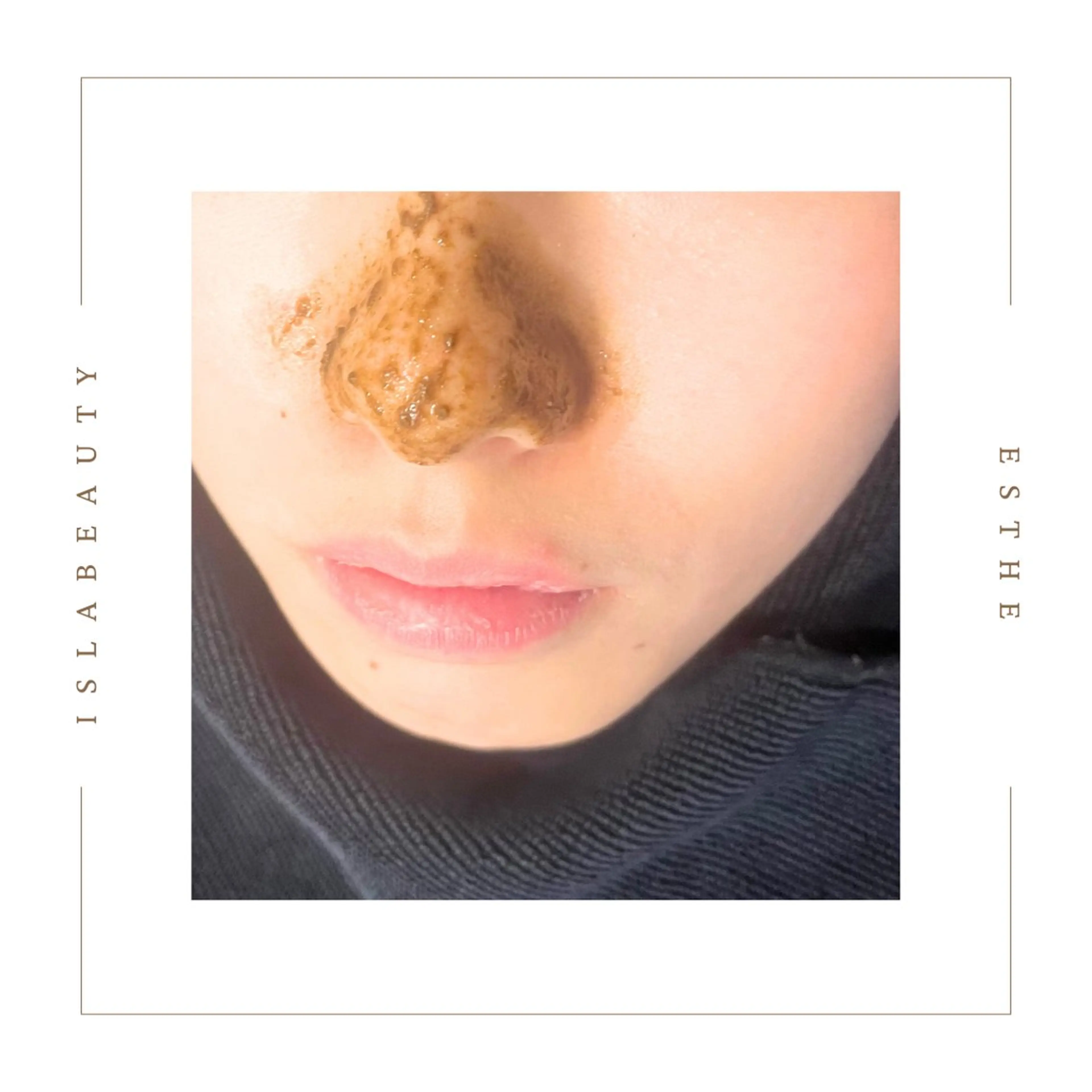 《毛穴の黒ずみ》【鼻のみ👃/ハーブピーリング🌿】剥離なし/鼻を徹底的にケアの写真