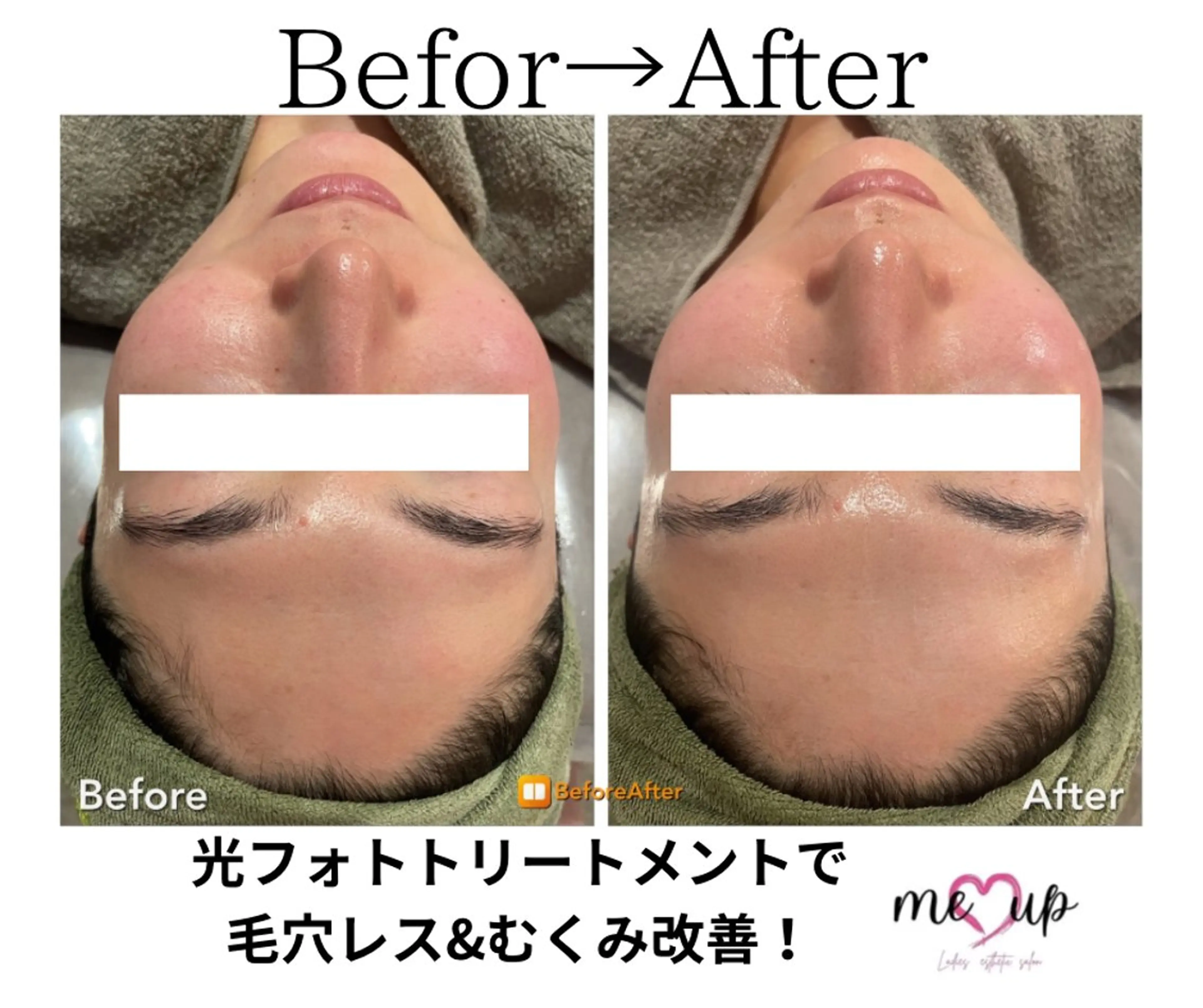 エステ Meupニキビ専門店 背中/ハーブ/肌管理のその他イメージ