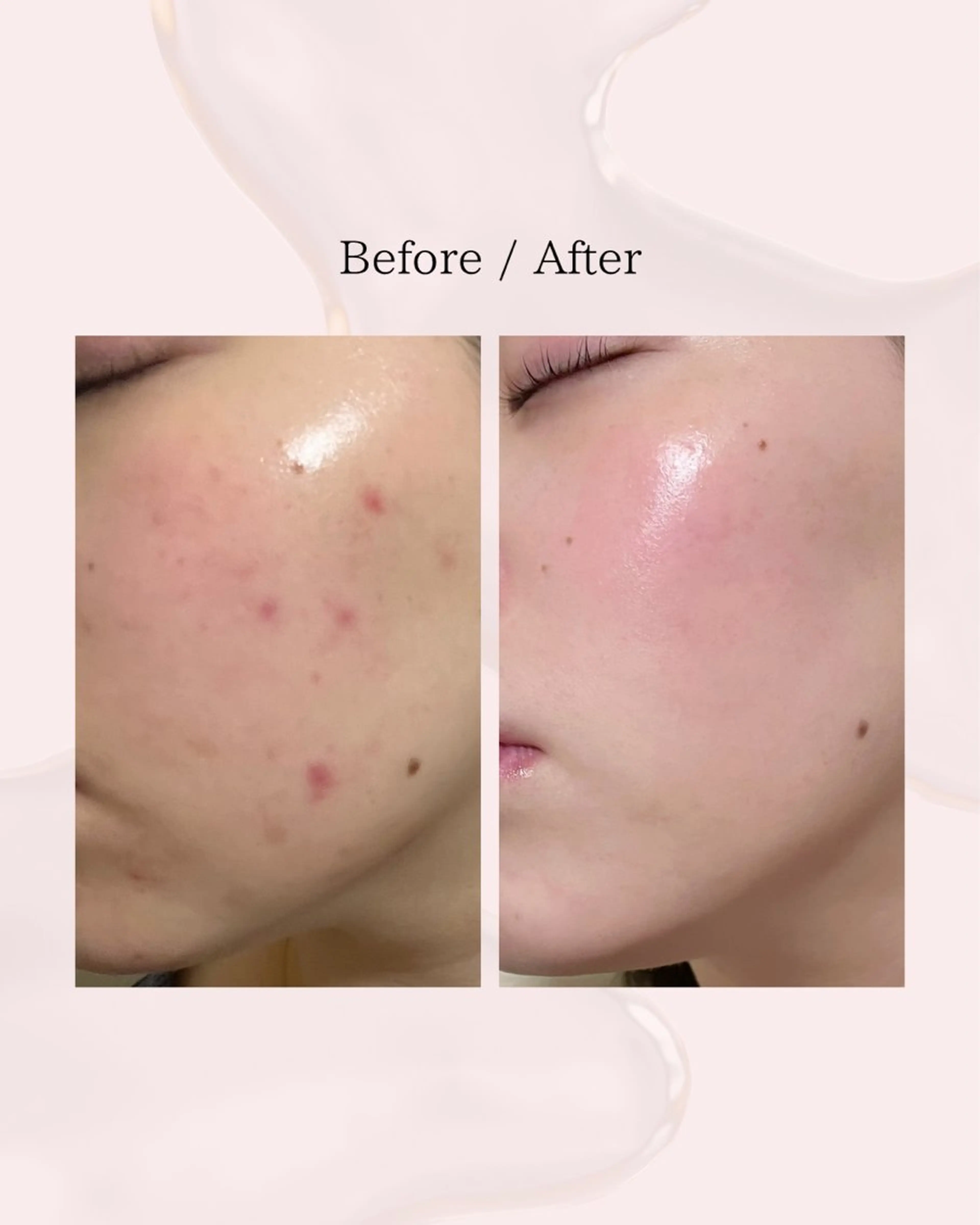 エステ myherb所属・ニキビ肌改善 ハーブピーリング🌿のエステ・リラクイメージ