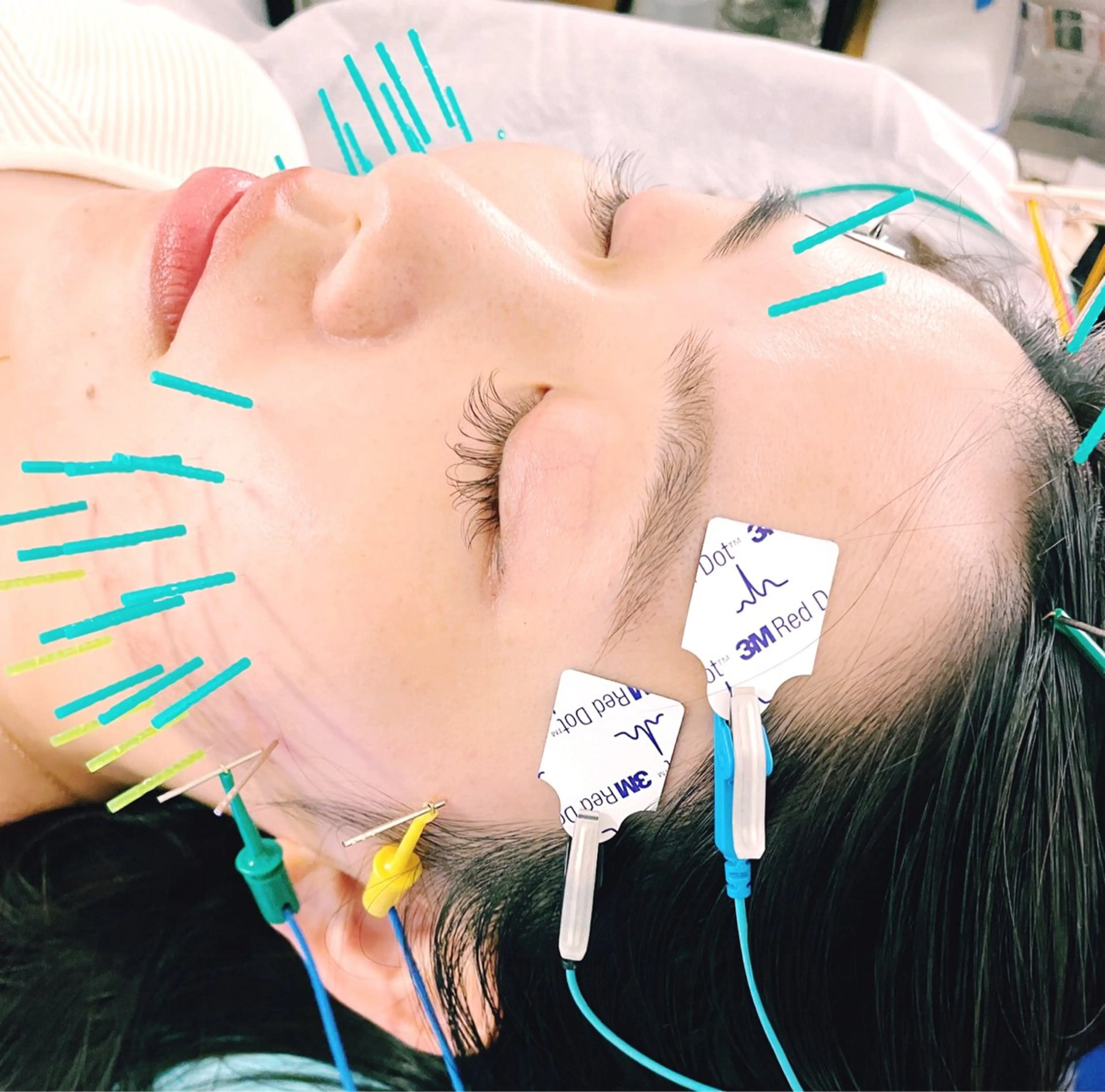 撮影モデル 小顔美容鍼専門サロン 渋谷YZのエステ・リラクイメージ