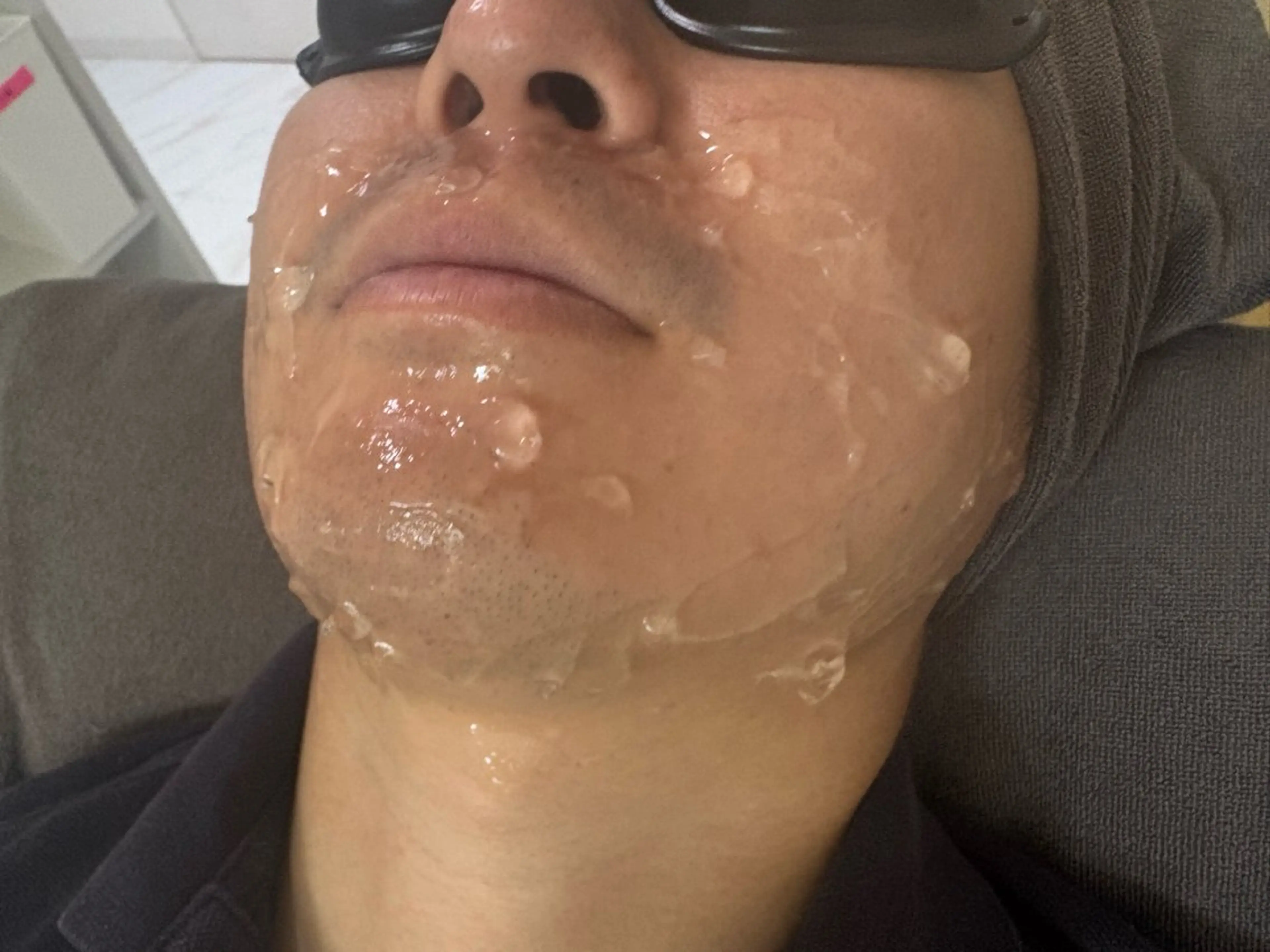 男性ヒゲ脱毛！の写真