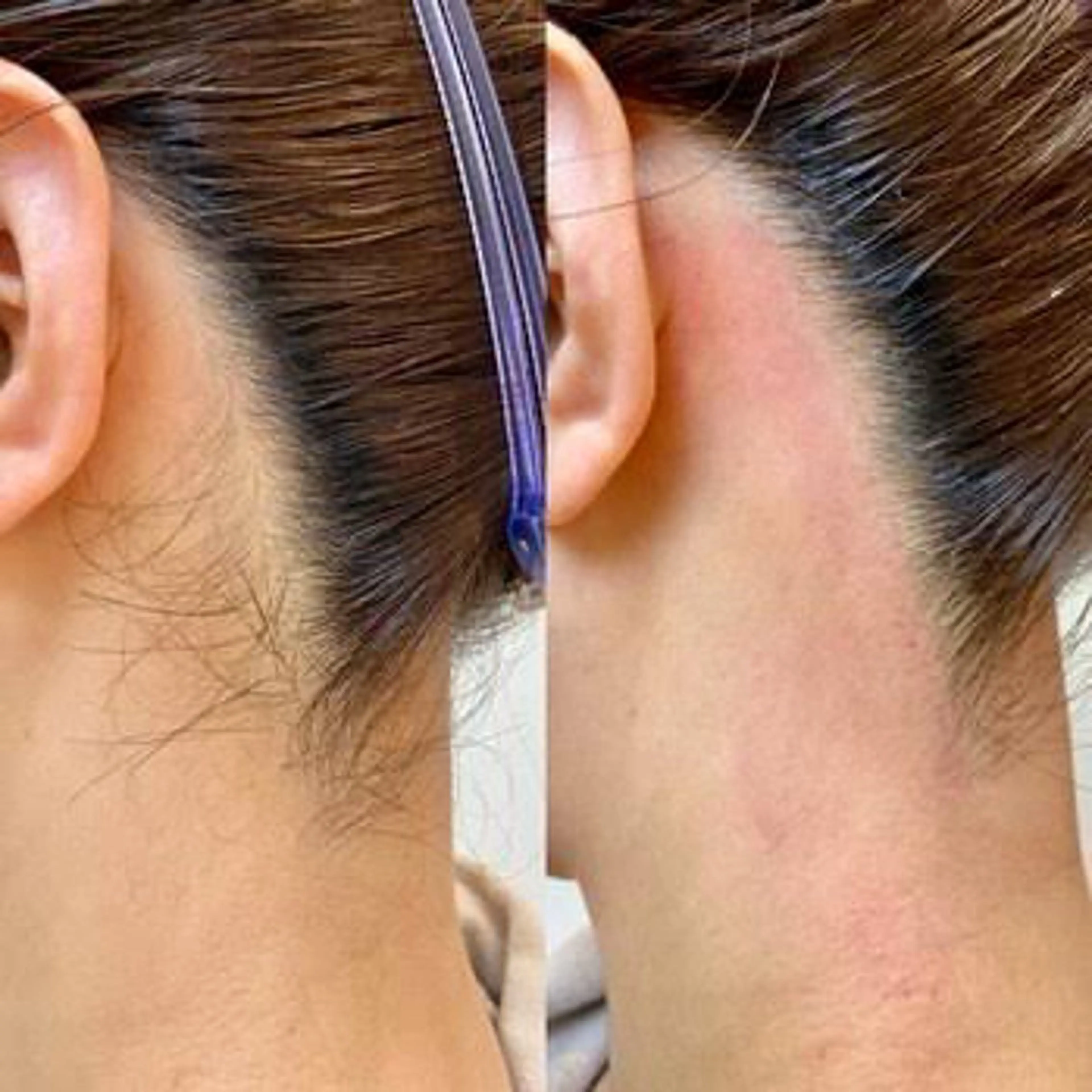 【後ろ姿美人】うなじワックス脱毛+デザイン込みの写真