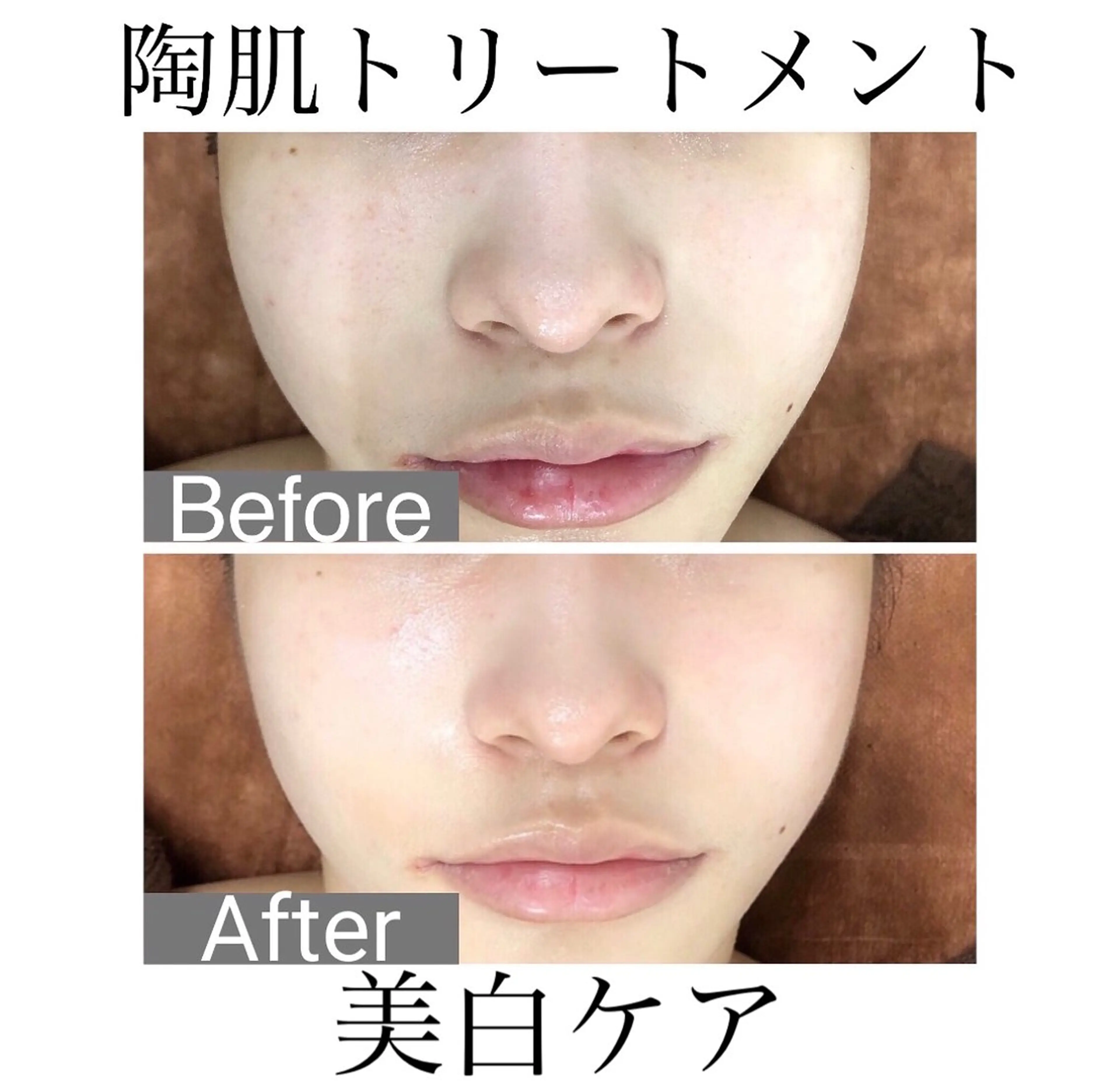 【ミニモ限定💡ハーブピーリング】美白ケアの写真