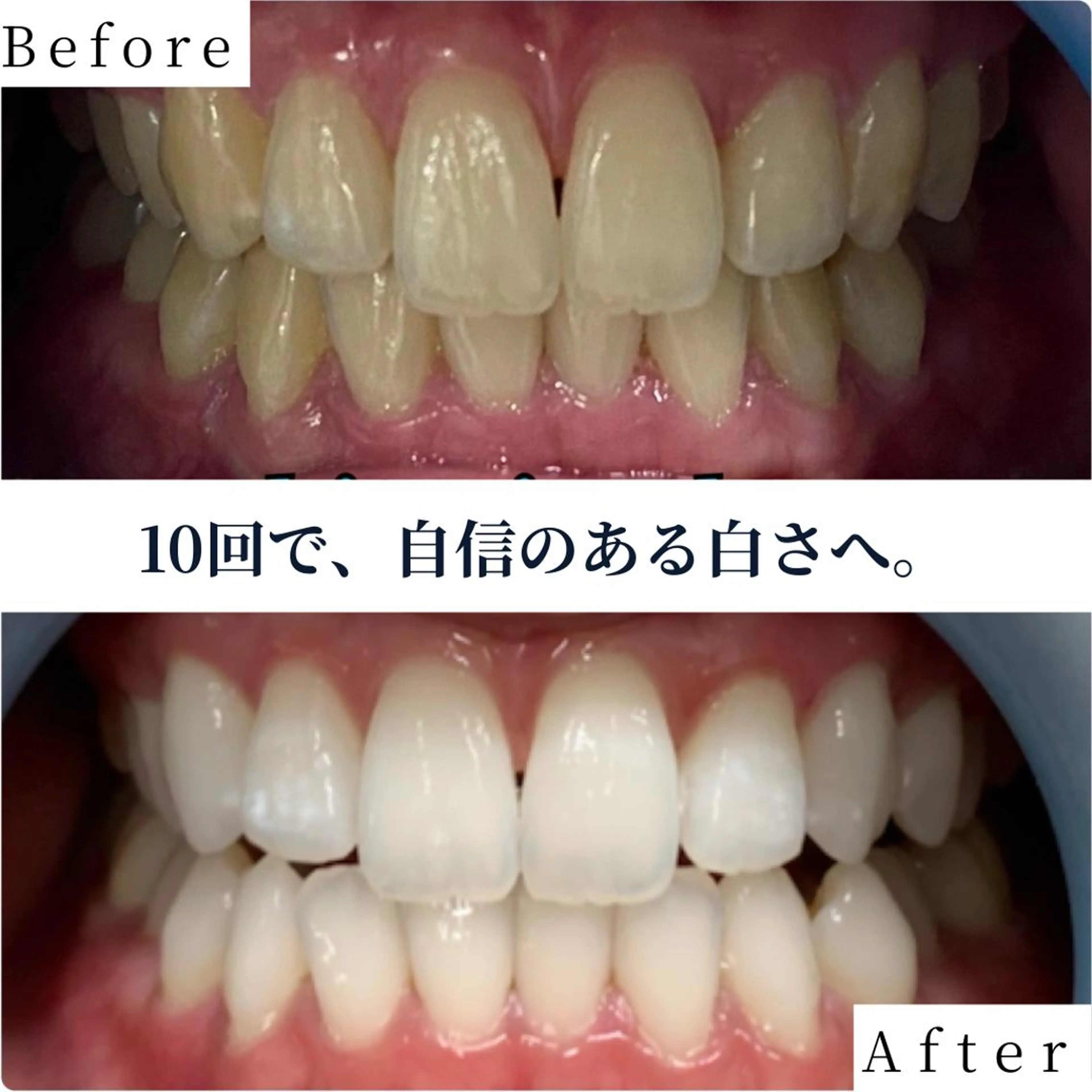 【確実に白くなりたい方必見🌹✨】フリーパスコース 40分照射×10回来店 ¥55000の写真