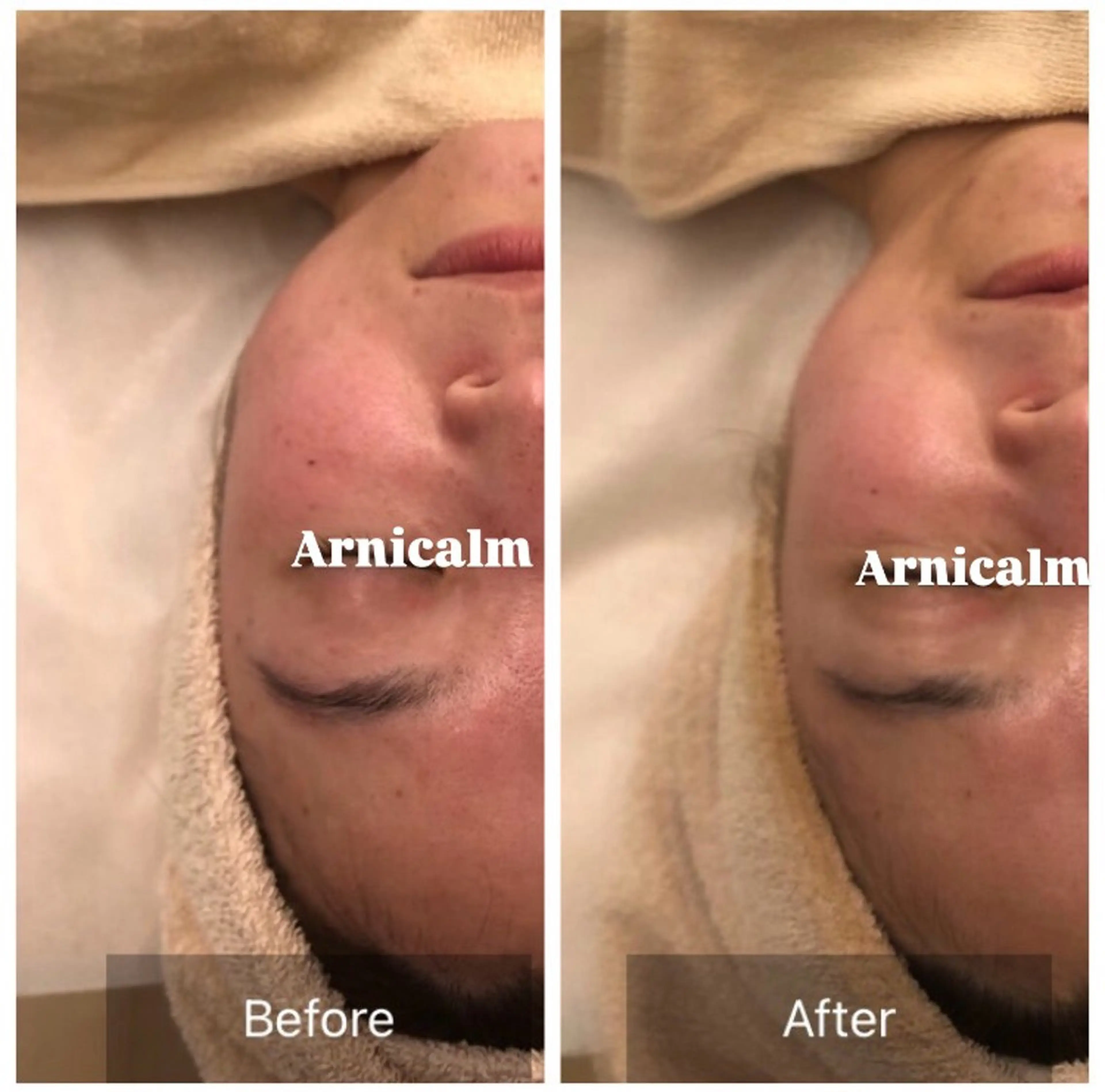 エステ ハーブピーリング 肌再生ピーリング/のエステ・リラクイメージ