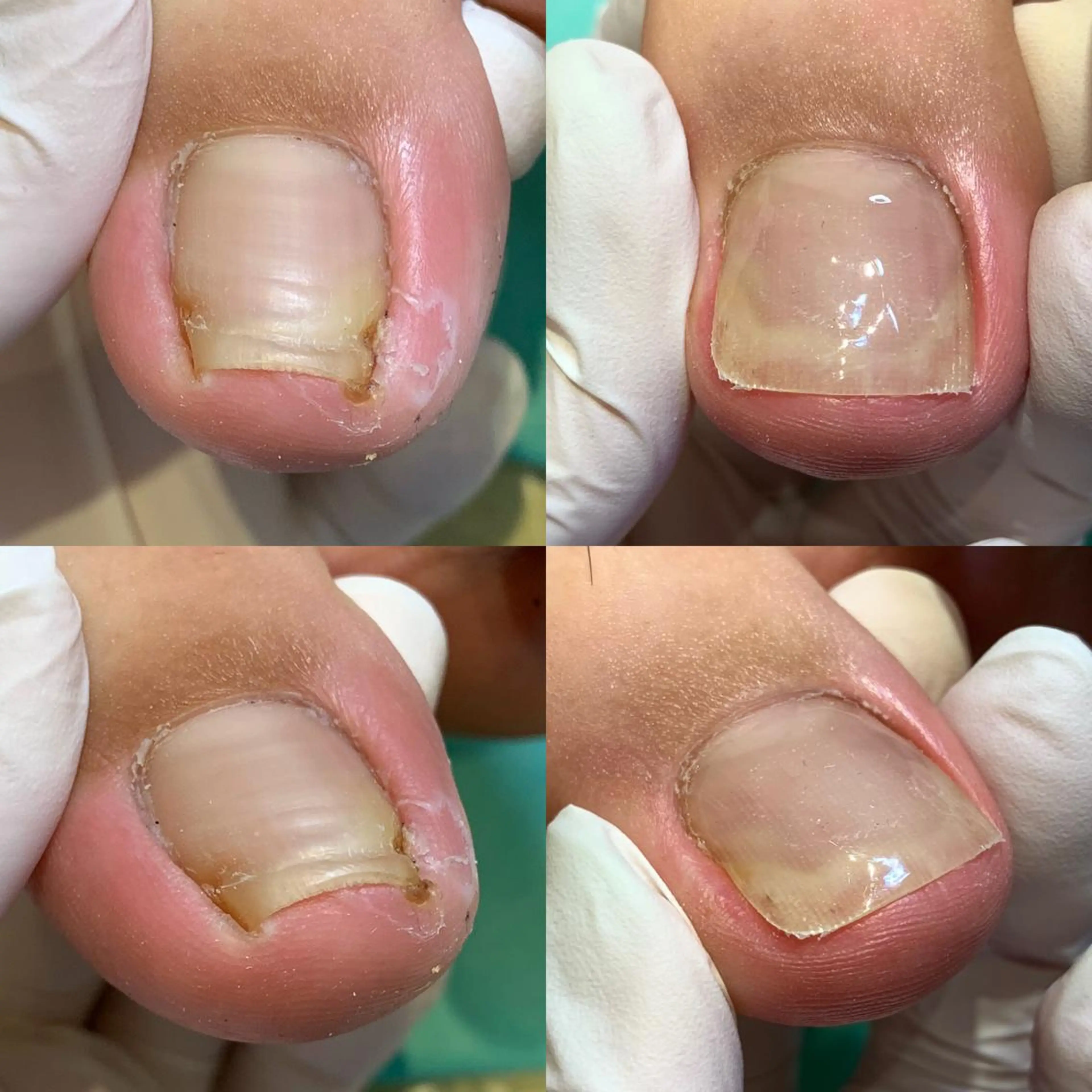 【陥入爪】朗報✨【🉐2回目以降もずっと"施術料が500円🉐】 1爪巻き爪補正✨皮膚に沈み込んだ爪も矯正器具でキレイ✨の写真