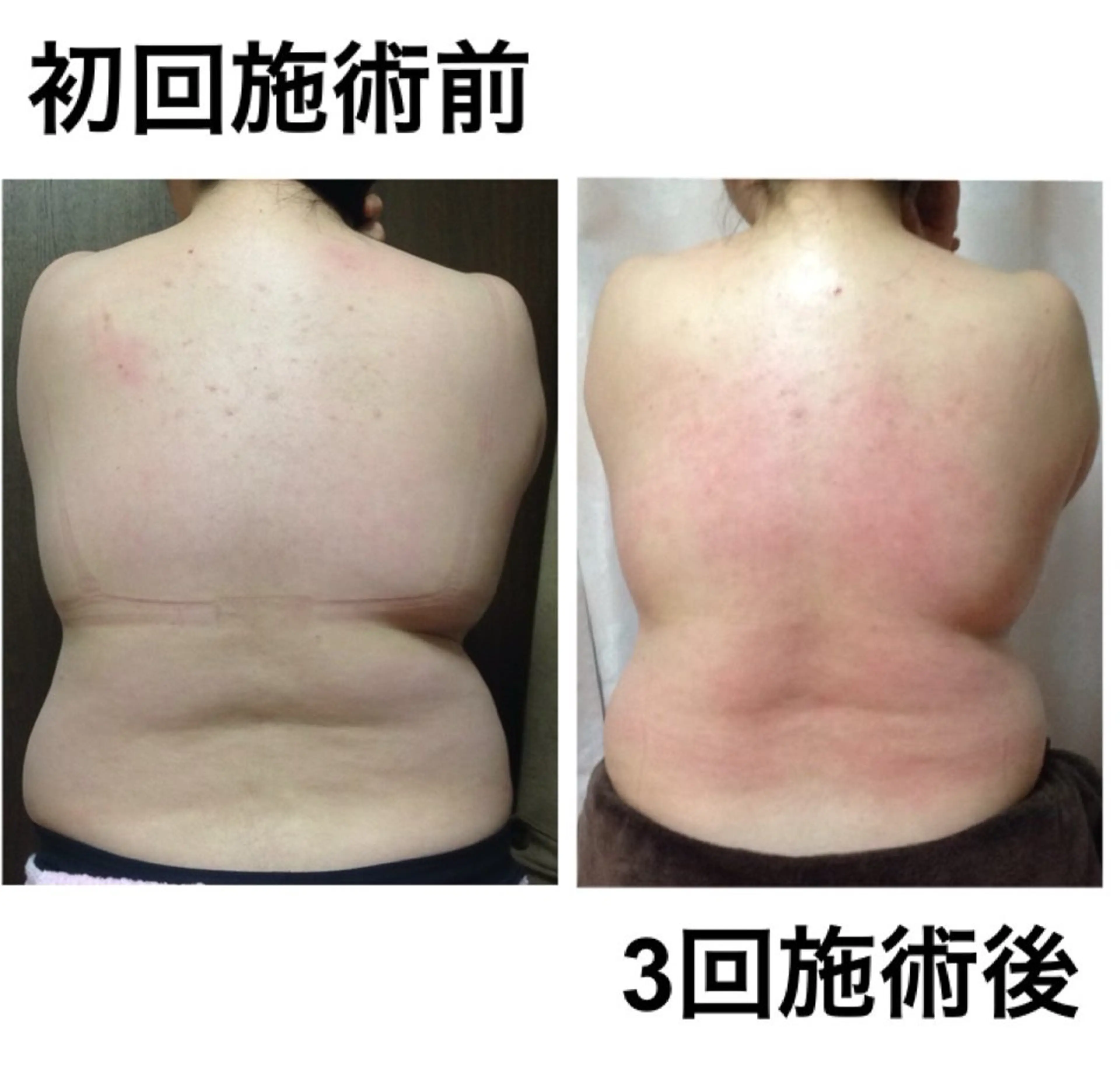 夏までに！ -5kgチャレンジのエステ・リラクイメージ