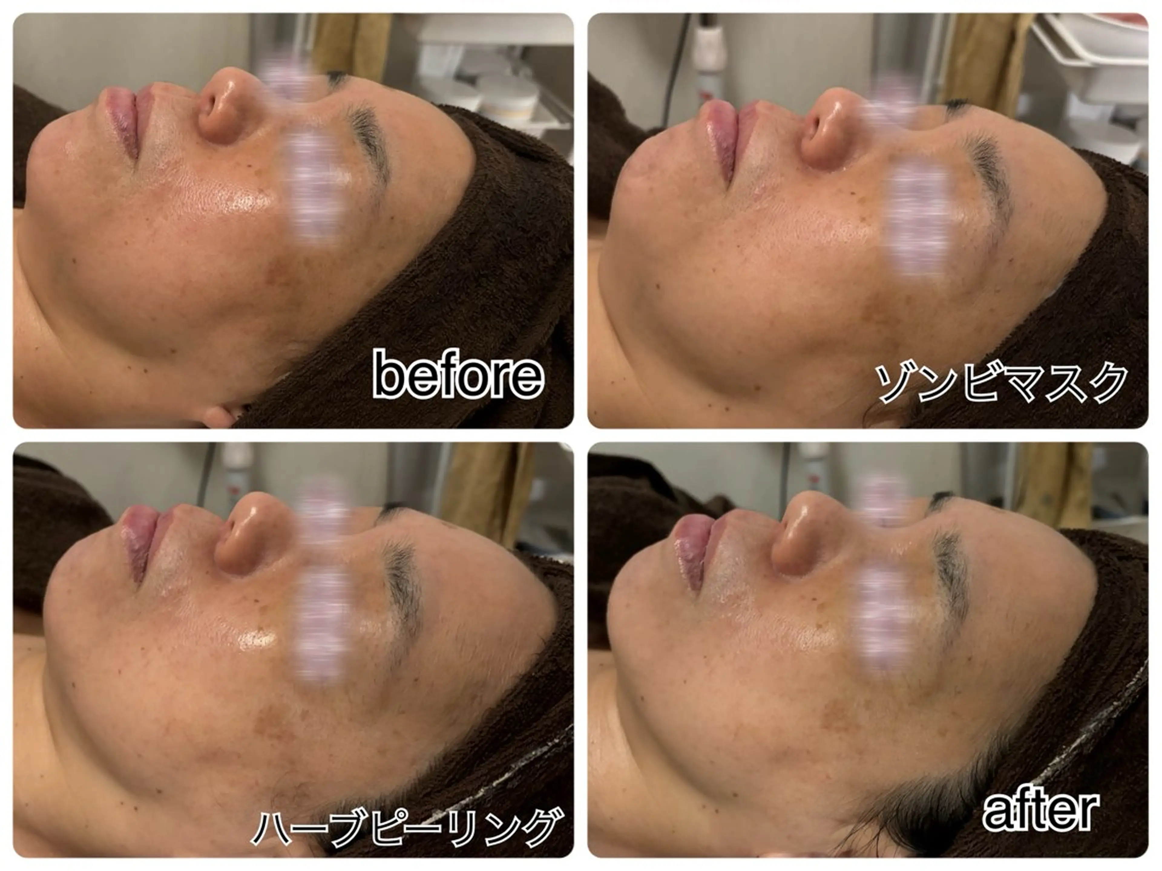 💎複合肌悩み90分✨ゾンビマスク+ハーブピーリングで毛穴・ニキビ・シミ・シワケア💖の写真