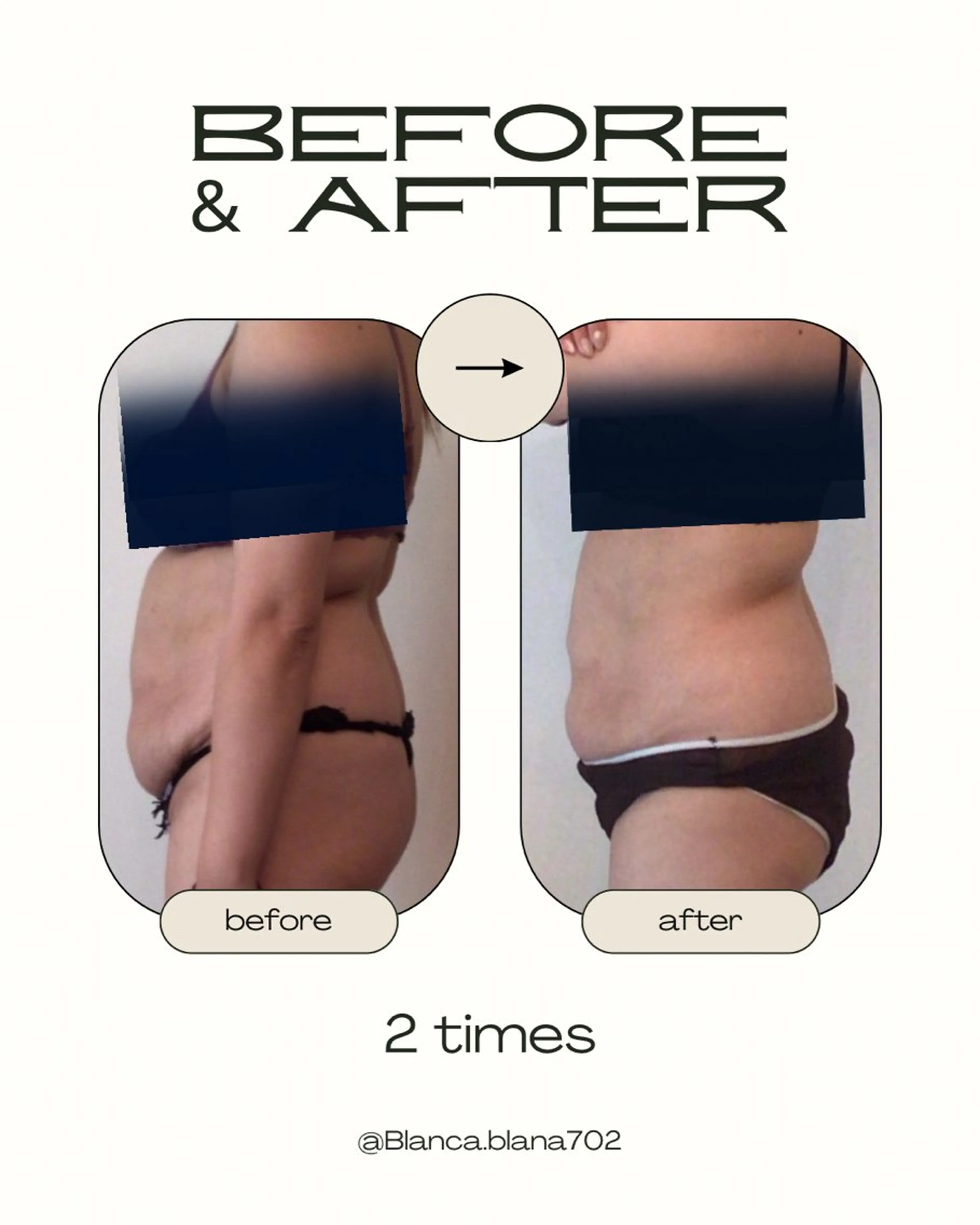 寝るだけでサイズダウン🧊30分の写真