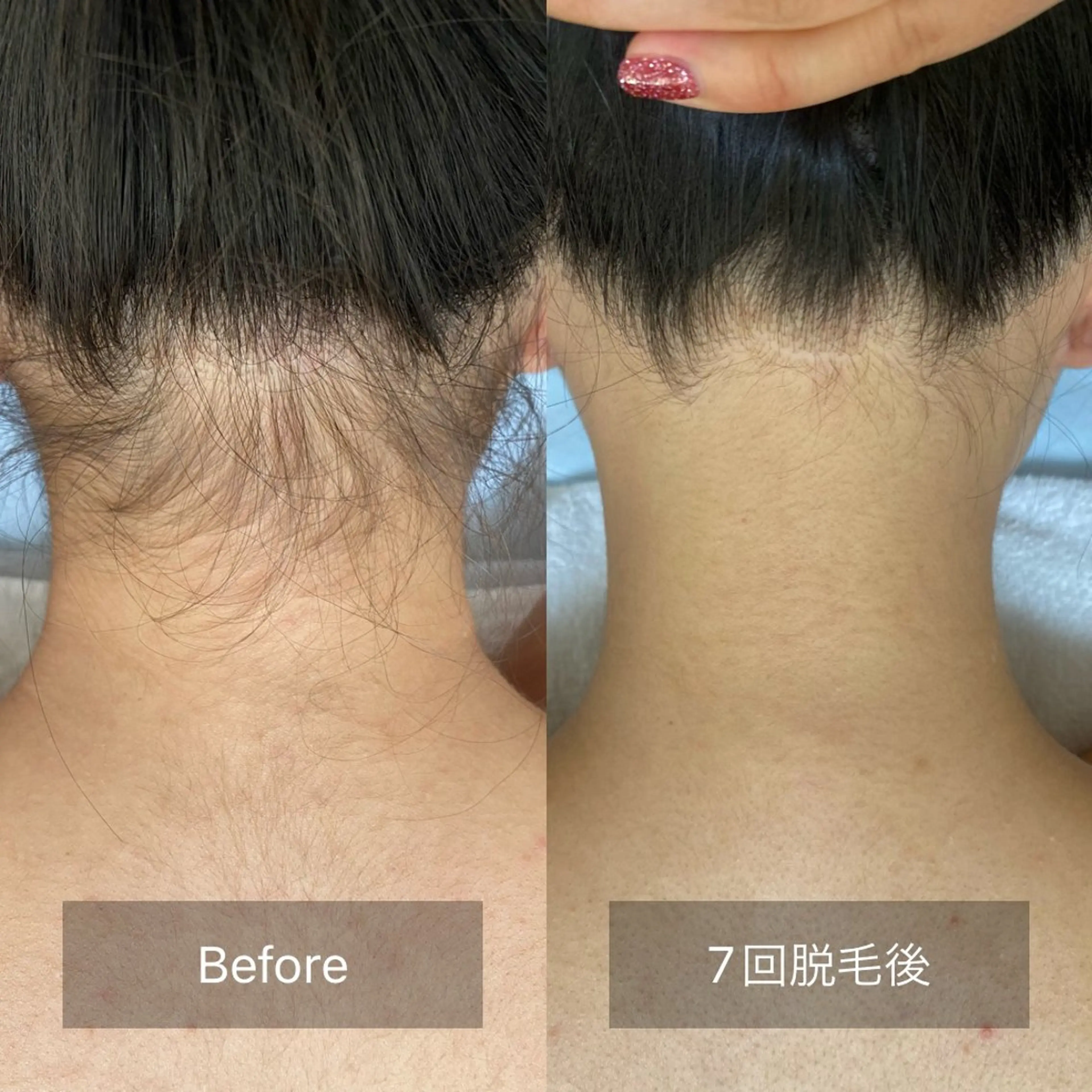 【レディース】顔＆VIO含む全身脱毛　うなじ脱毛こだわってます⭐︎の写真