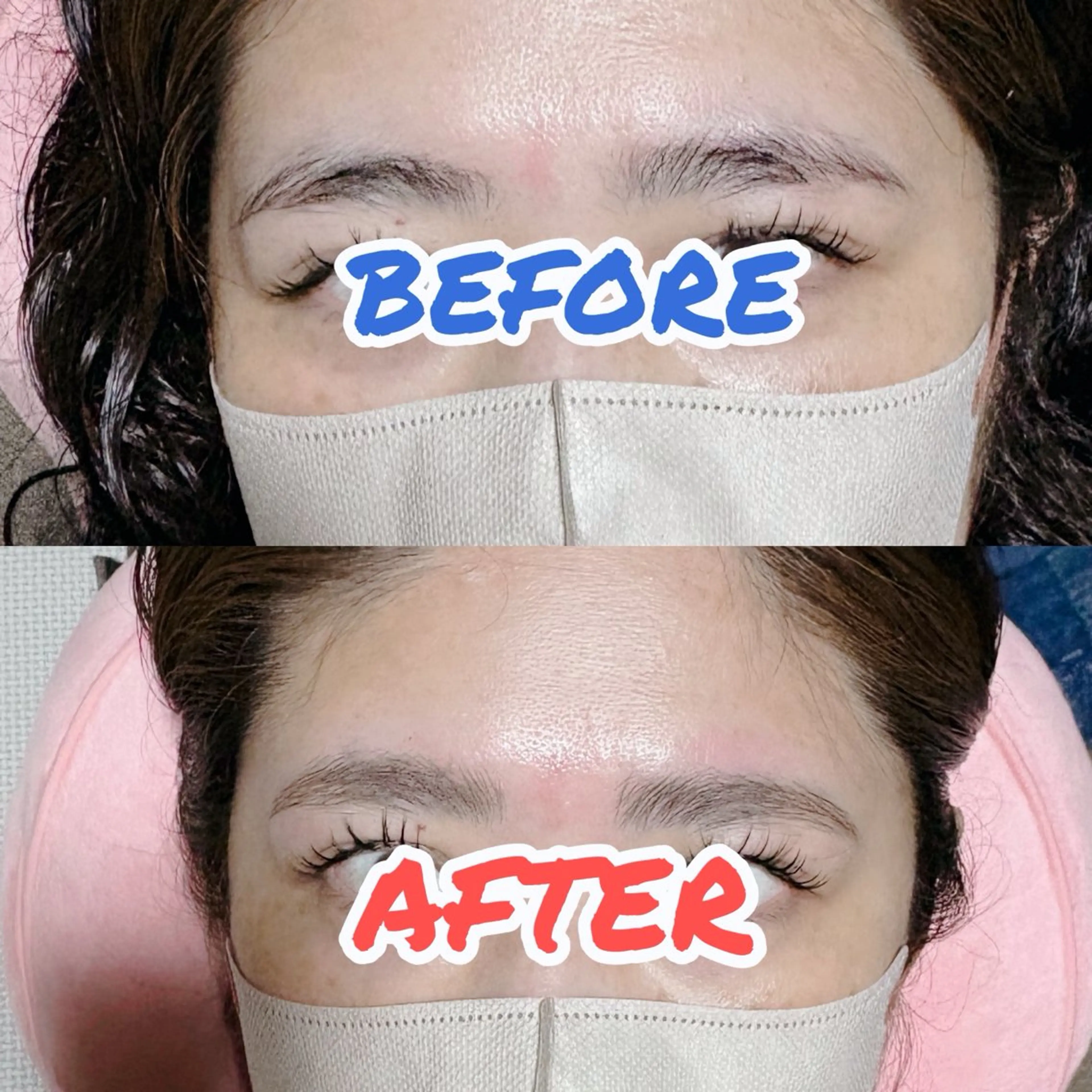 HBL（ハリウッドブロウリフト）カウンセリングの写真