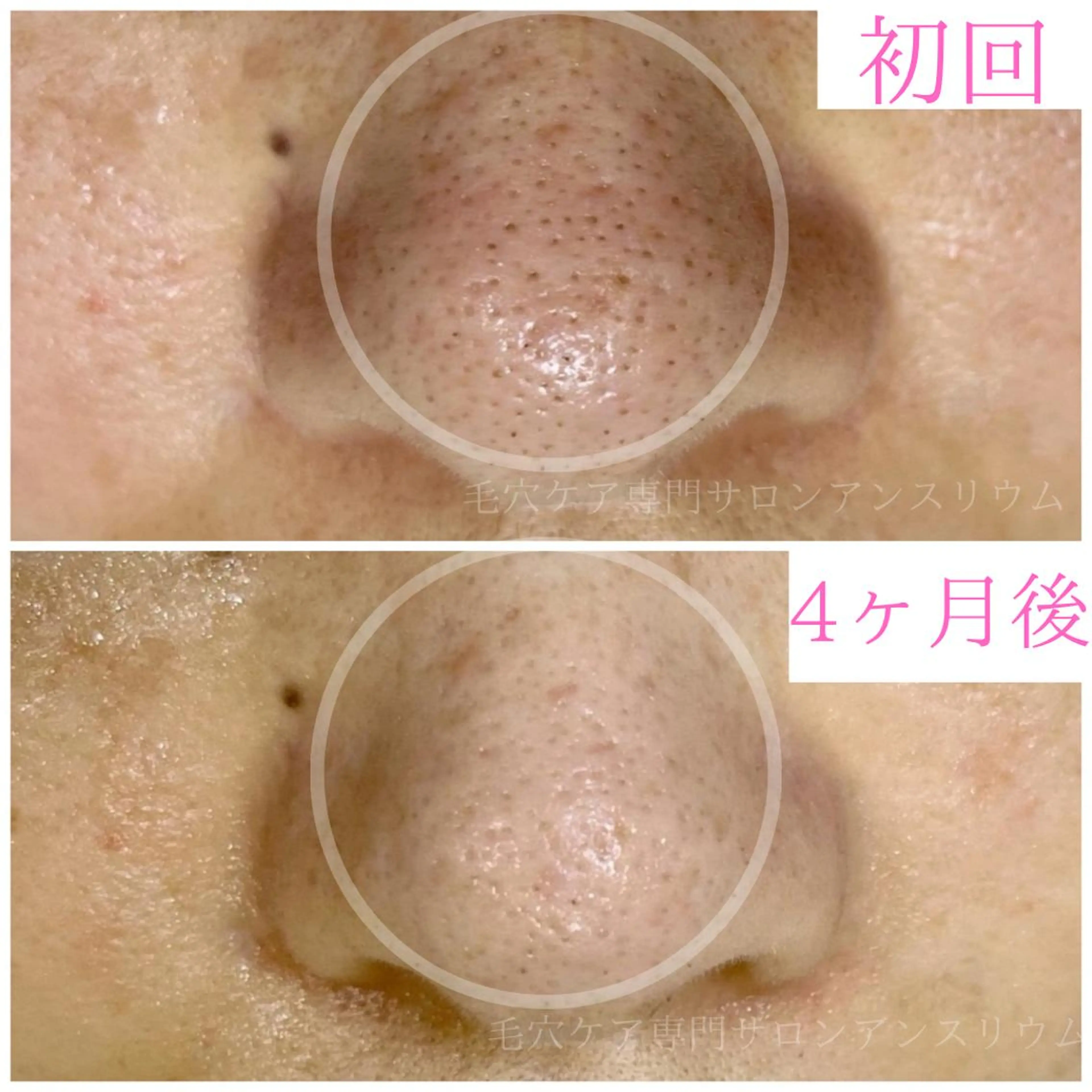 毛穴ケア専門サロンアンスリウム所属・茨城土浦 つくば毛穴 ケア専門サロンのエステ・リラクイメージ