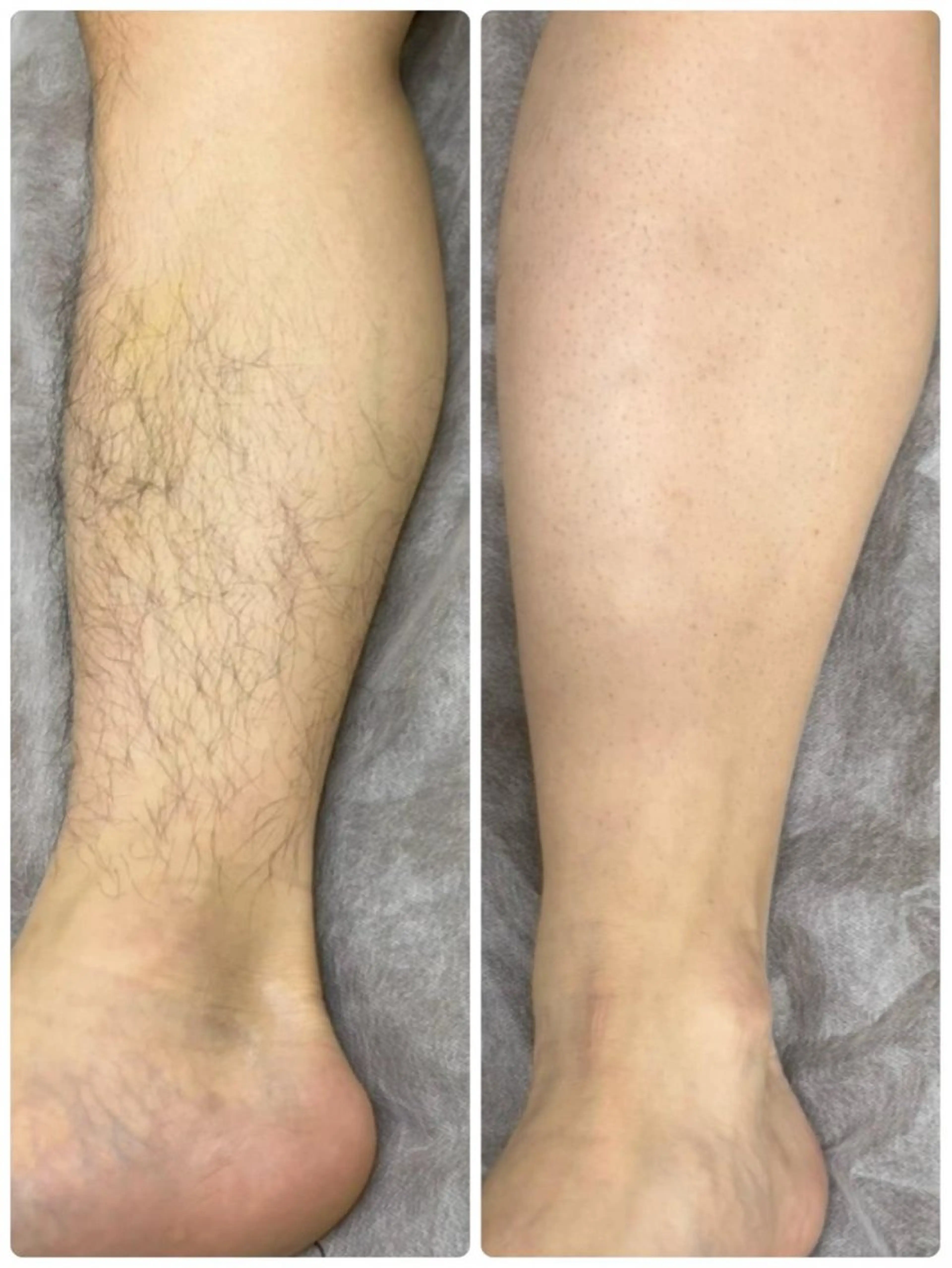 夏のムレ撃退✨下半身脱毛(両足VIO込)の写真