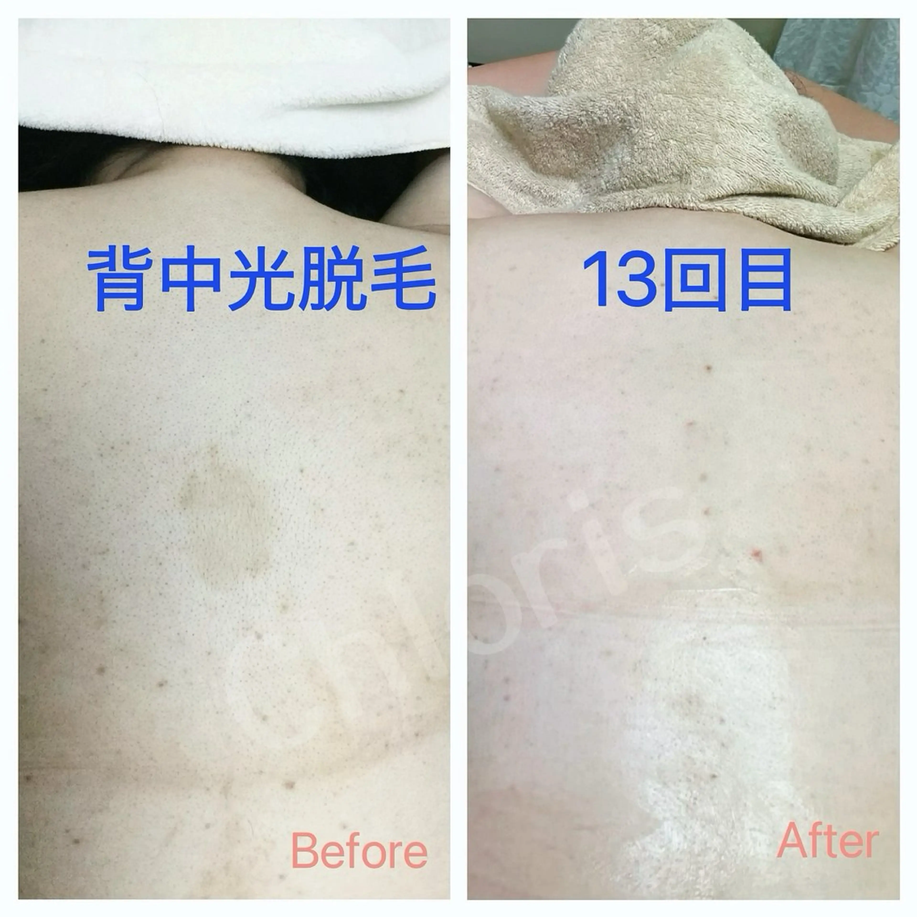 【初回限定】　《光脱毛》背中まるごと脱毛の写真