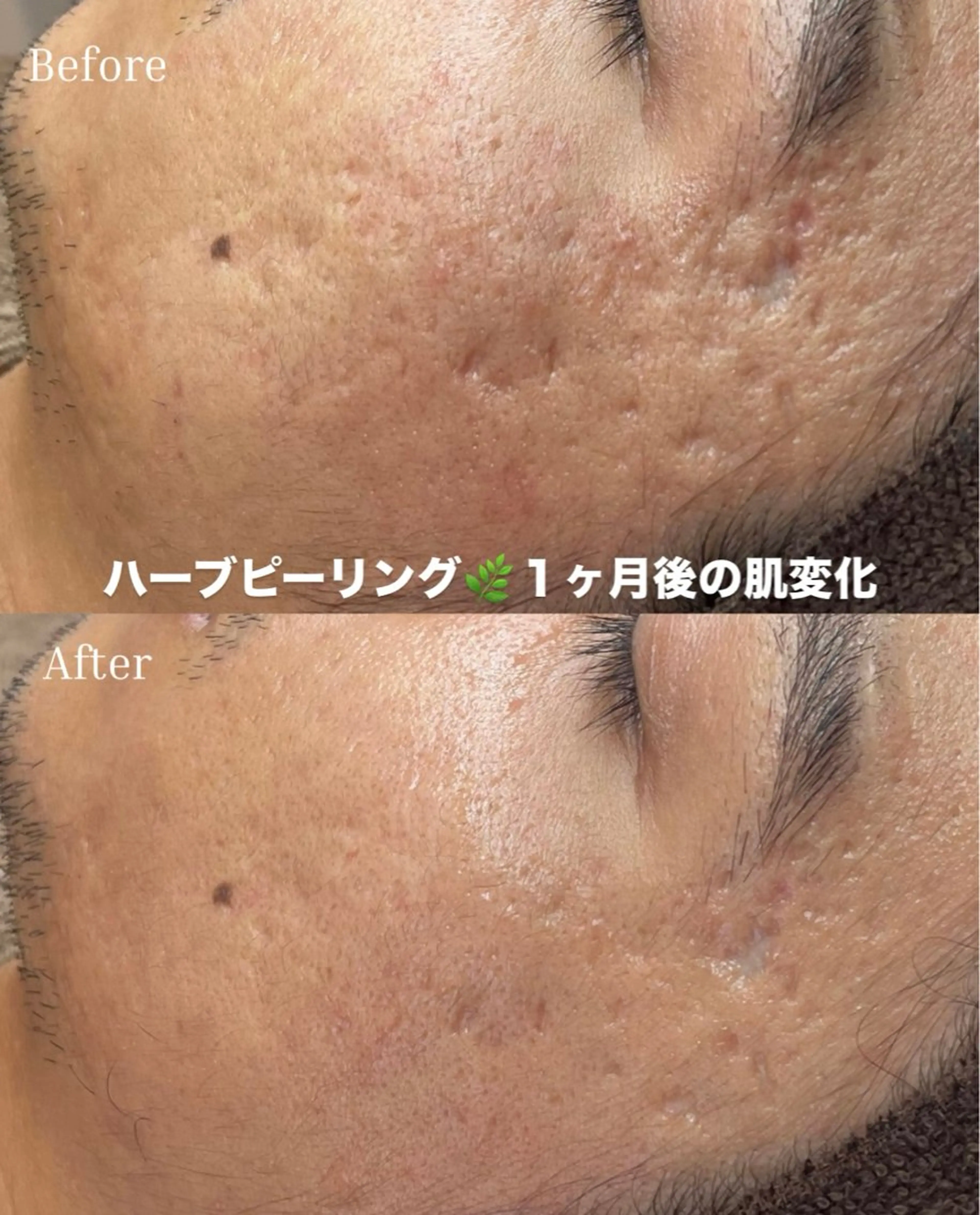 エステ BELLIS HUIT所属・ハーブピーリング那覇 BELLISHUITのエステ・リラクイメージ