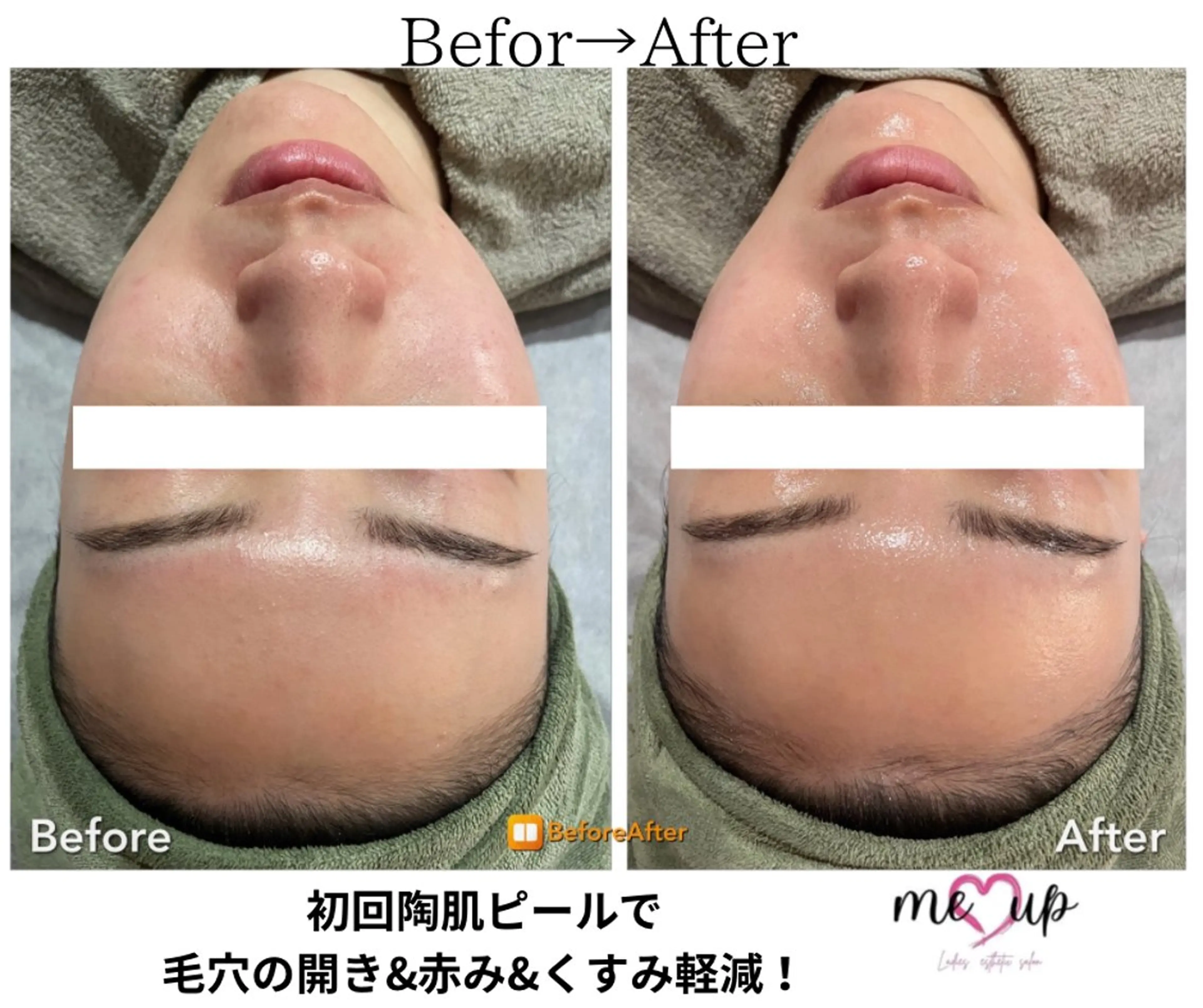 エステ Meupニキビ専門店 背中/ハーブ/肌管理のその他イメージ