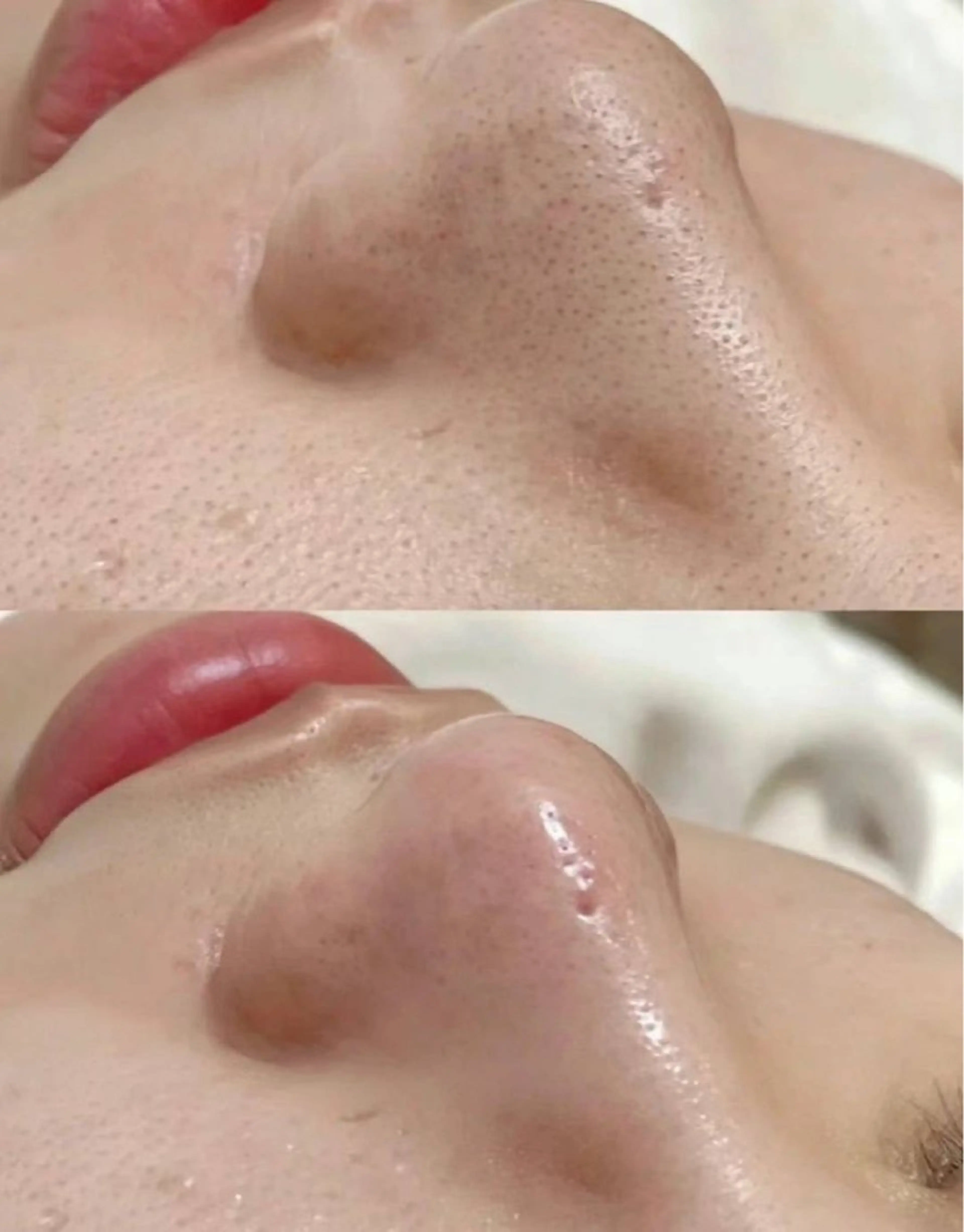 【頑固な毛穴奥の汚れ撃退】ハイドラ毛穴大掃除!!の写真