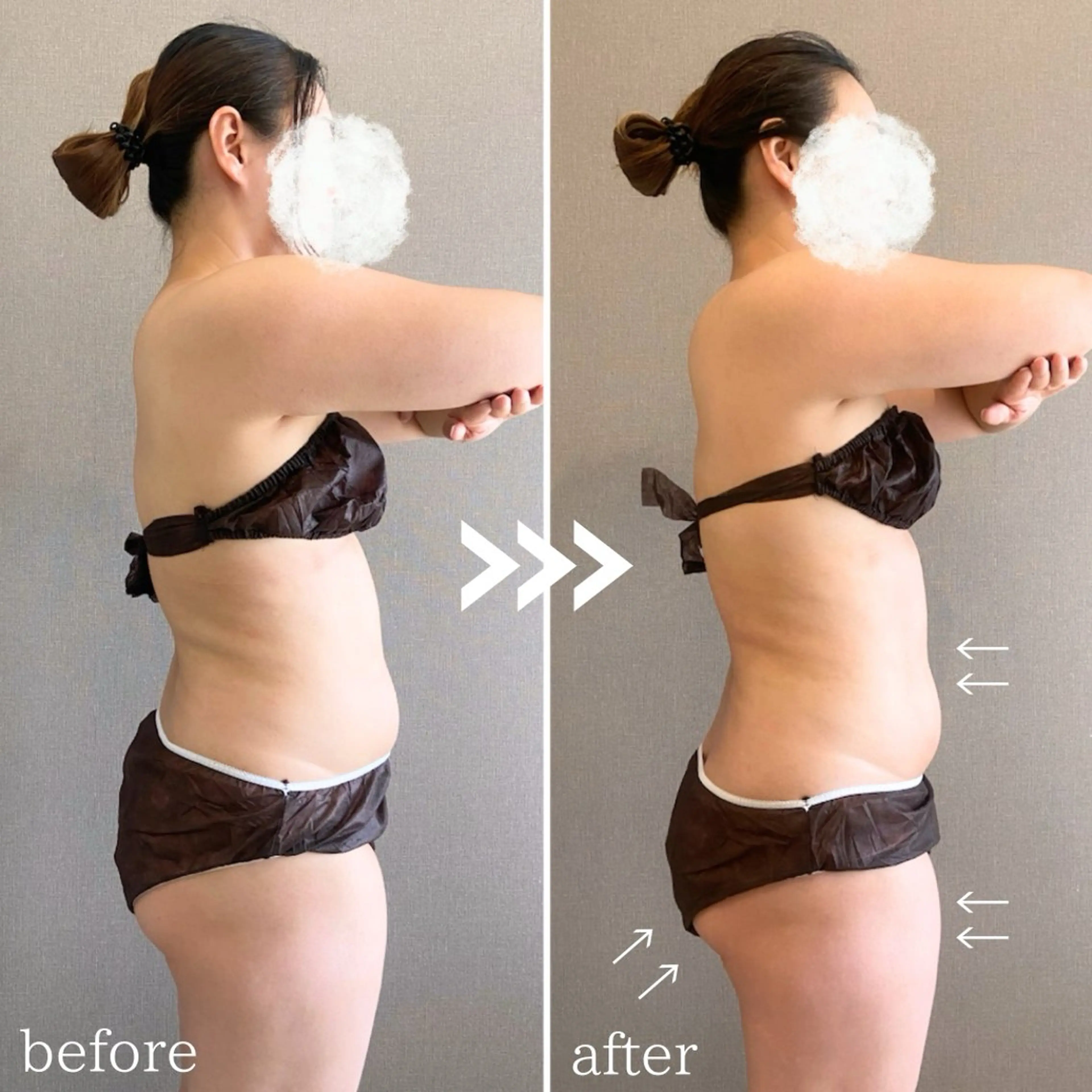 ダイエット応援価格‼️📣【二の腕、お腹、背中】最新機器を使い身体水脈を整え太りにくい身体に❣️の写真