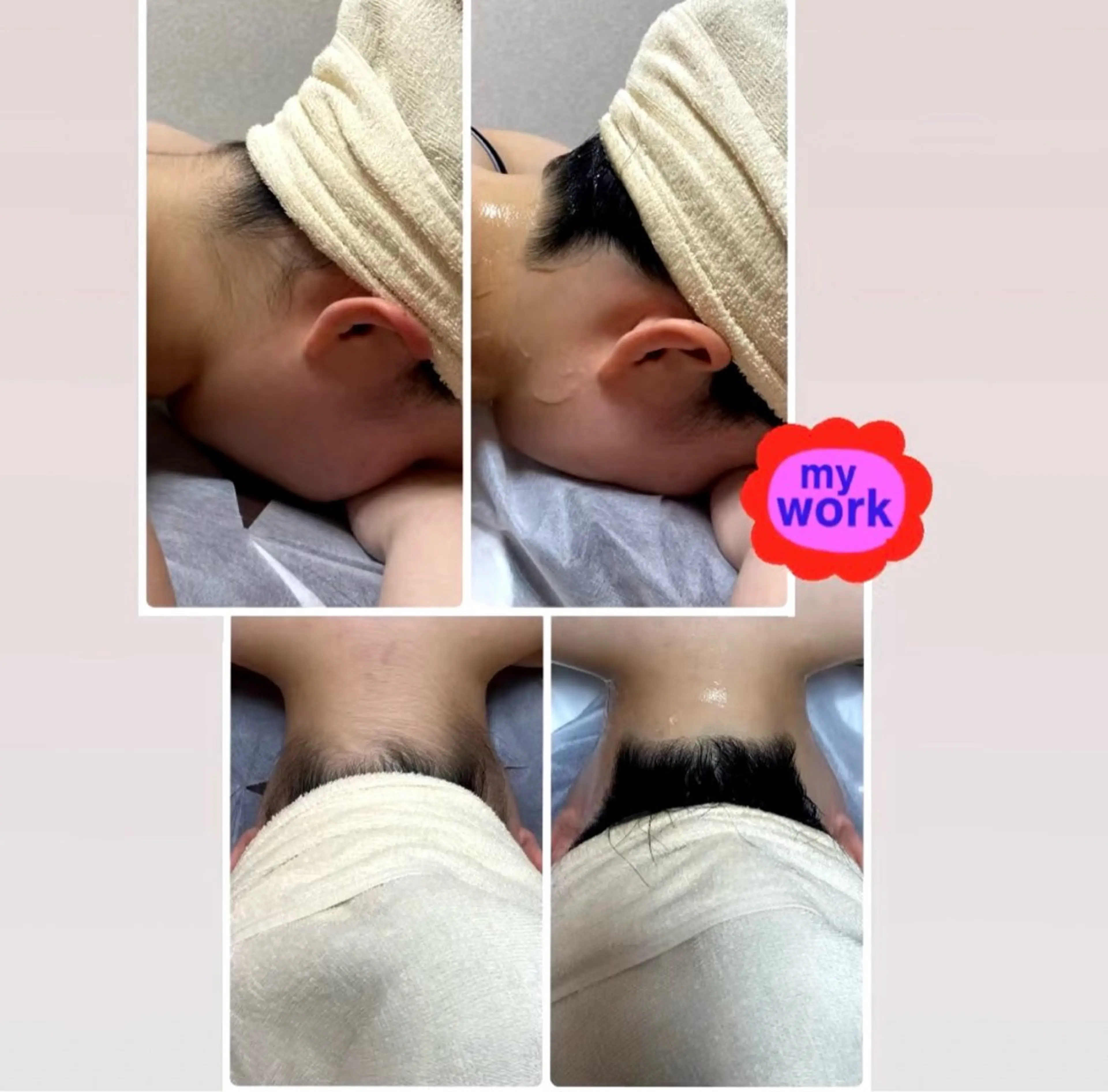 目指せうなじ美人❣️【うなじ脱毛】➕シェービング付き🪒髪の毛を短く切った方や髪を上げる事が多い方などにオススメ✨の写真