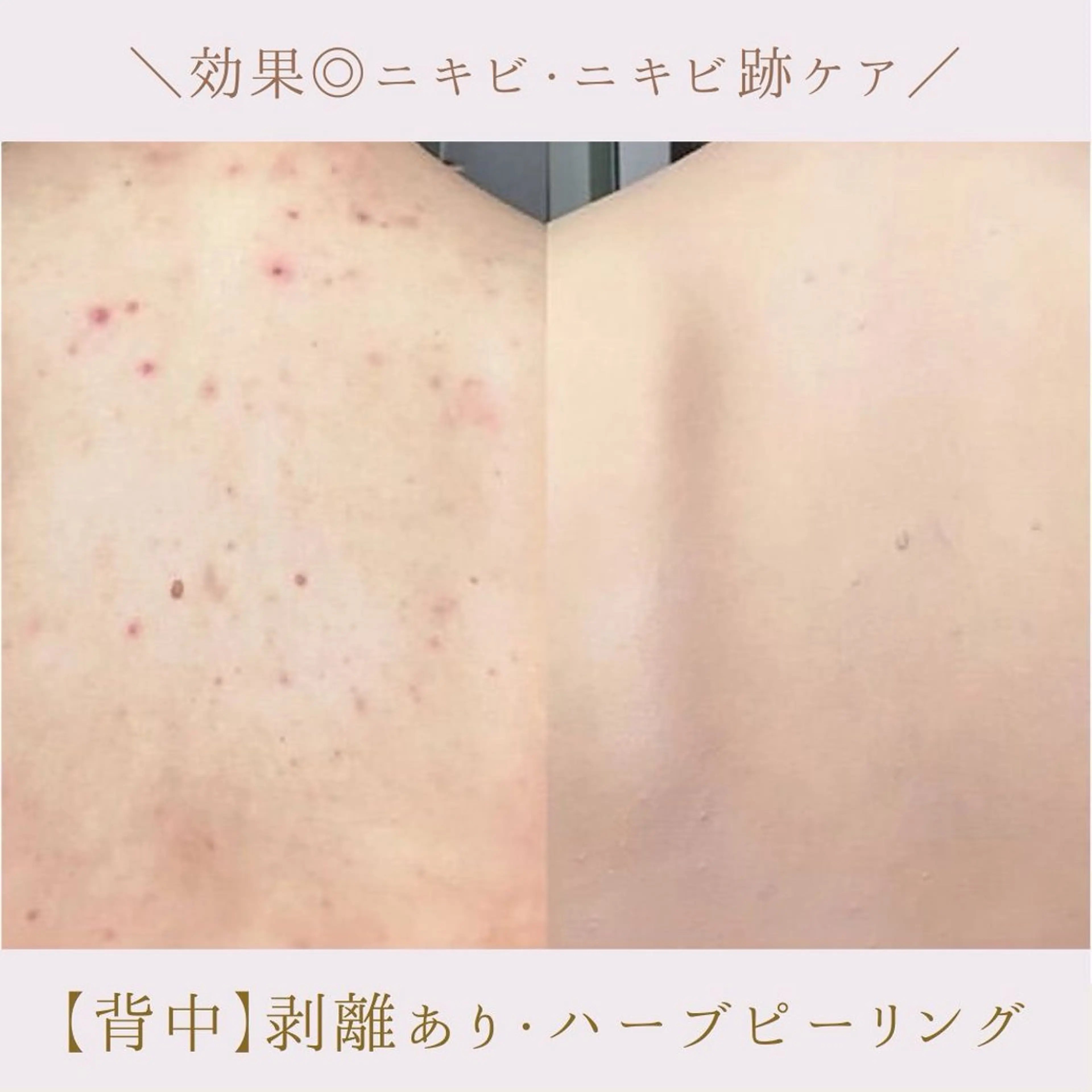 肌質改善サロン renew所属・肌質改善サロン renew/ｳｴｷのエステ・リラクイメージ