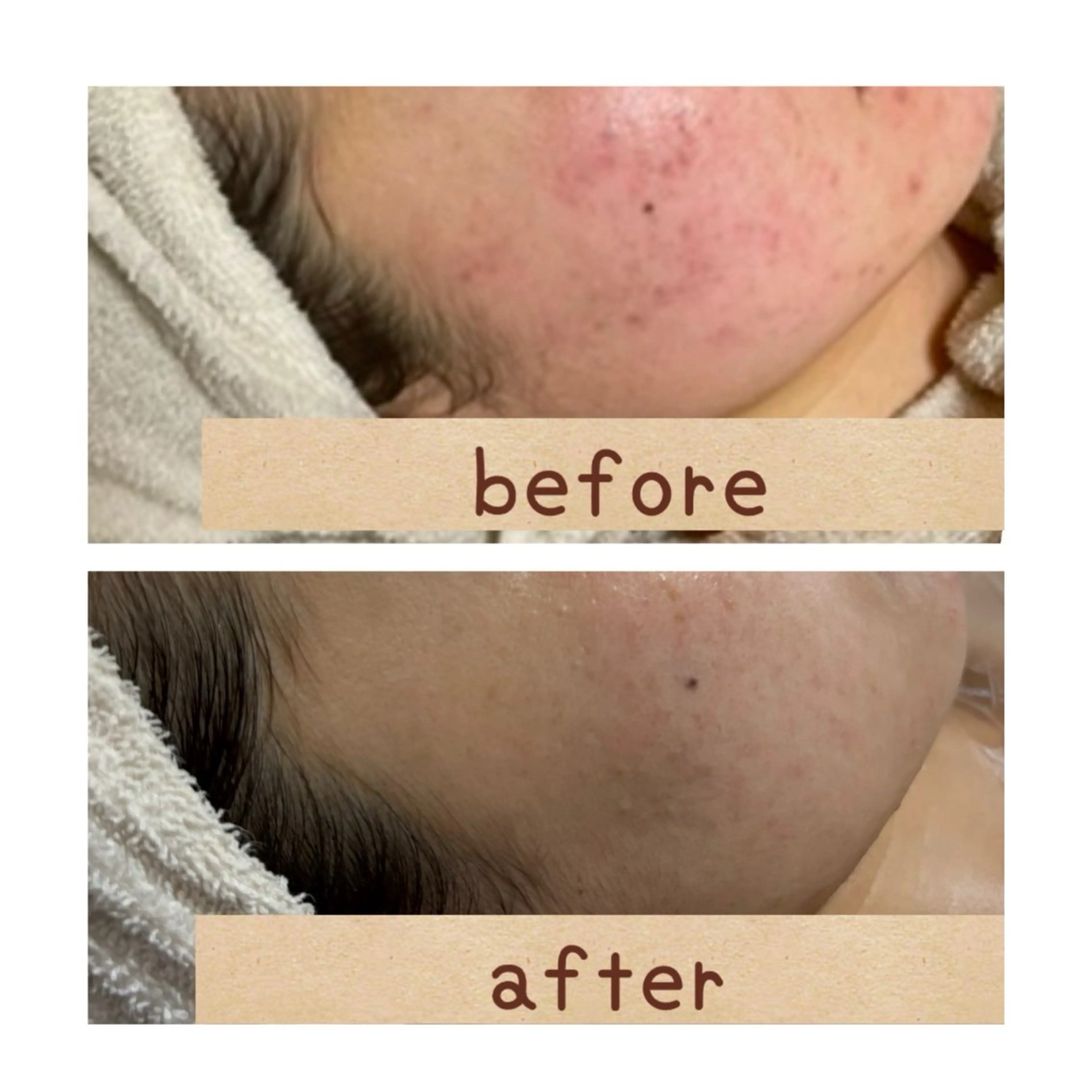 エステ 【前橋市】毛穴洗浄× オールハンドリンパのエステ・リラクイメージ