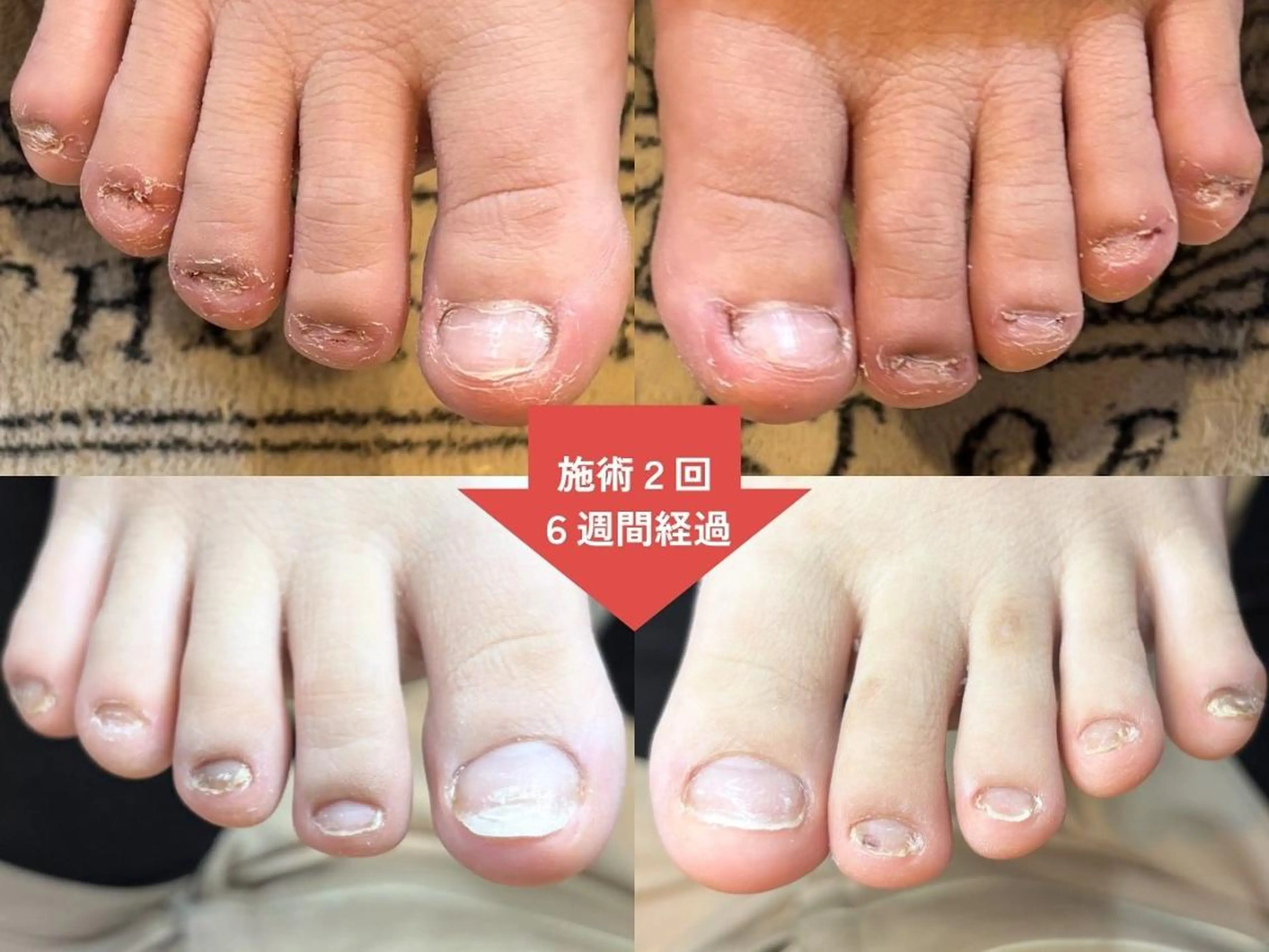 ネイル 深爪矯正・自爪育成 ネイルサロンアモまいのネイルデザイン