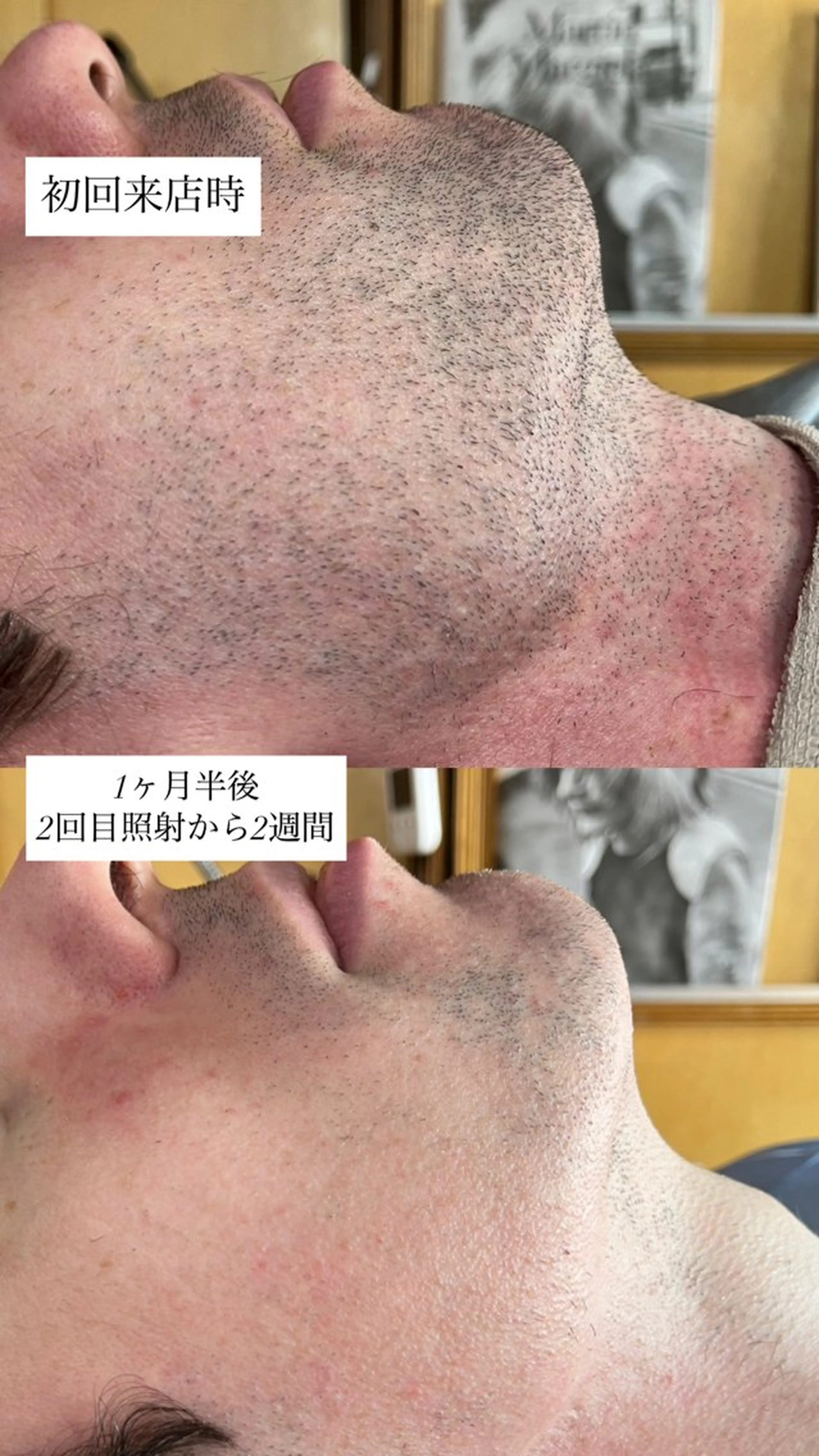 脱毛 littohair所属・岡田 杏のエステ・リラクイメージ