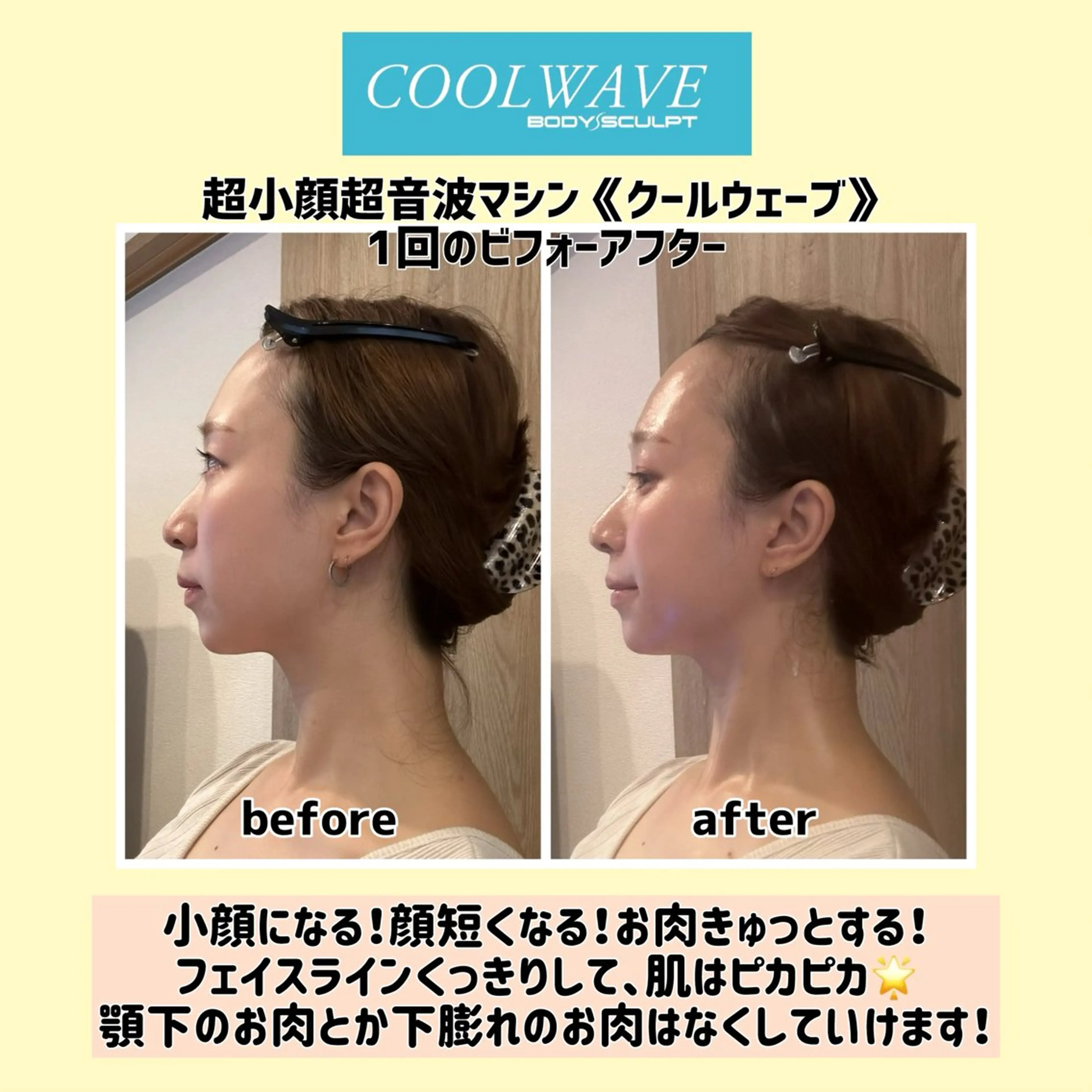 超小顔超音波マシン《クールウェーブ》の写真
