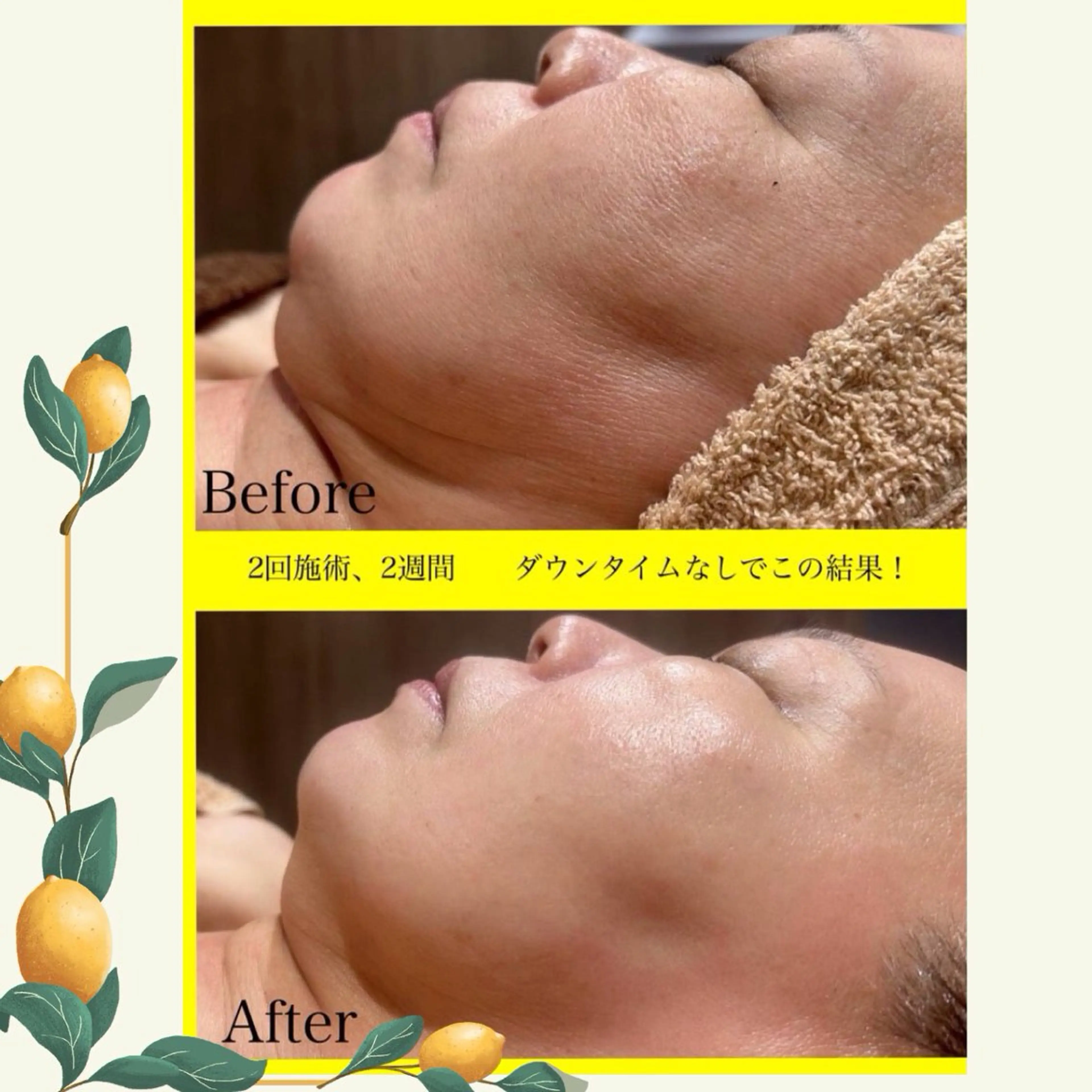【韓国発☆二重アゴ・即効小顔】脂肪溶かすLemonボトルフェイシャルの写真