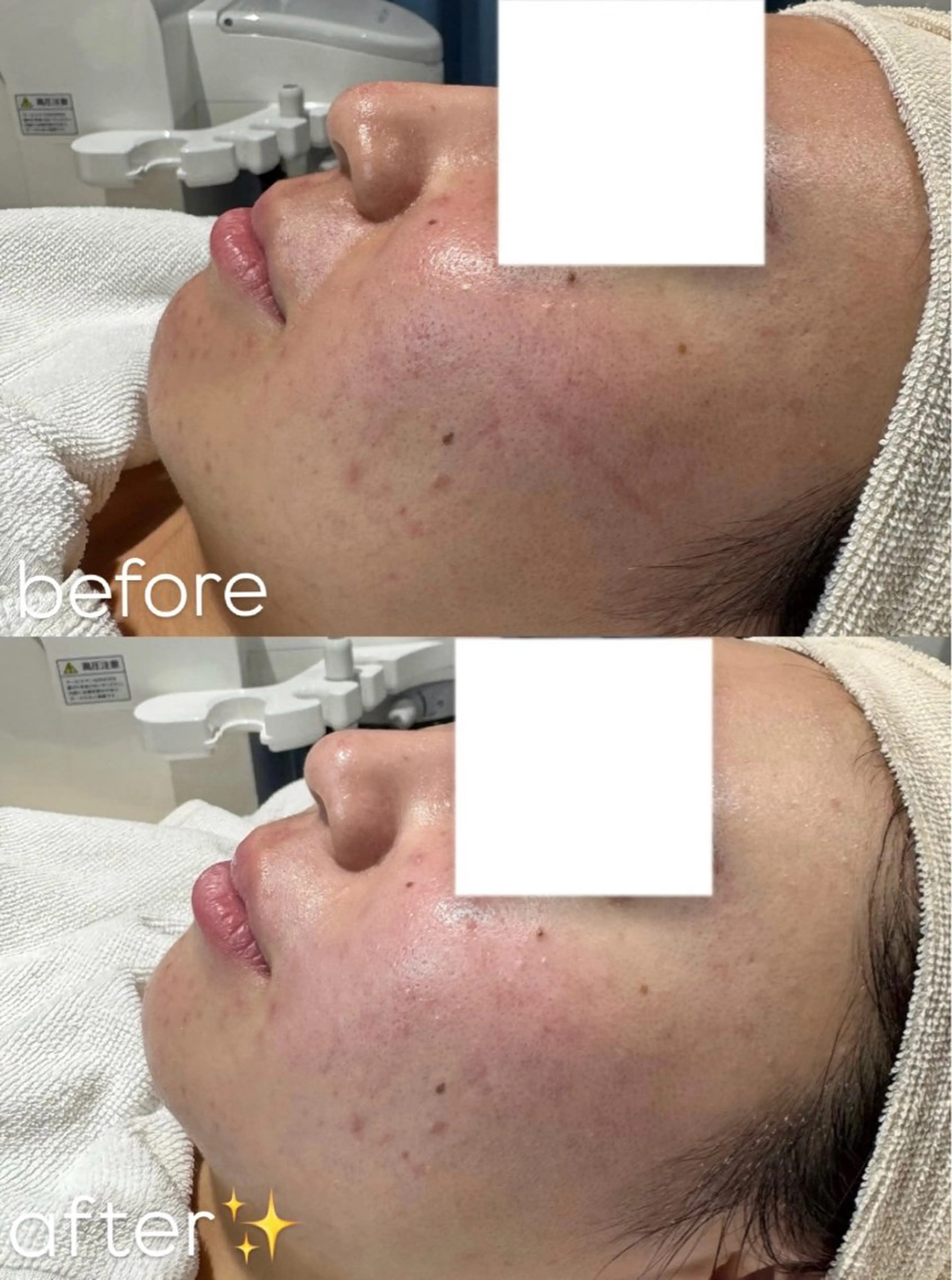 エステ 肌質改善/ mashikoのエステ・リラクイメージ