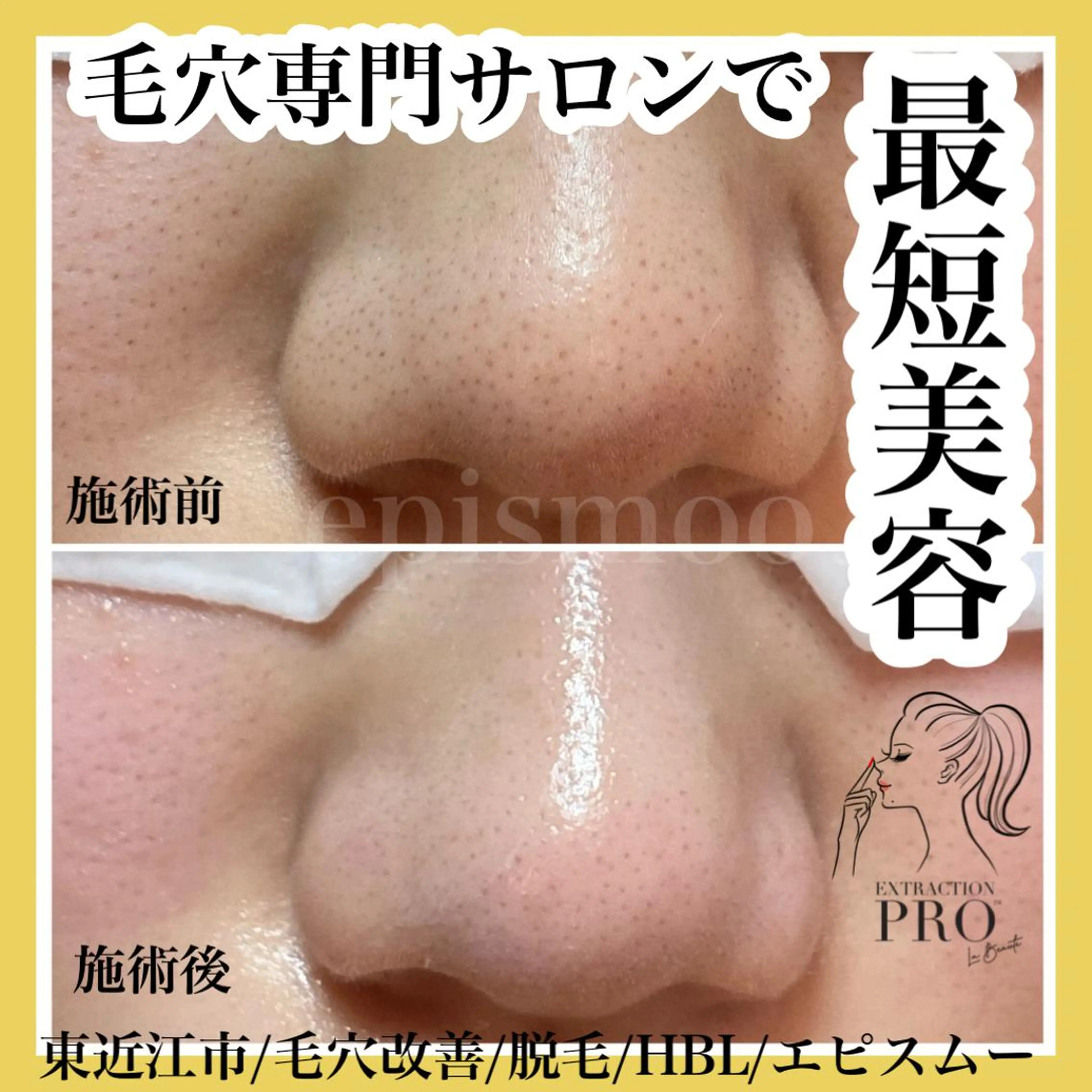 epismoo 脱毛/HBL/毛穴の眉毛・アイブロウイメージ