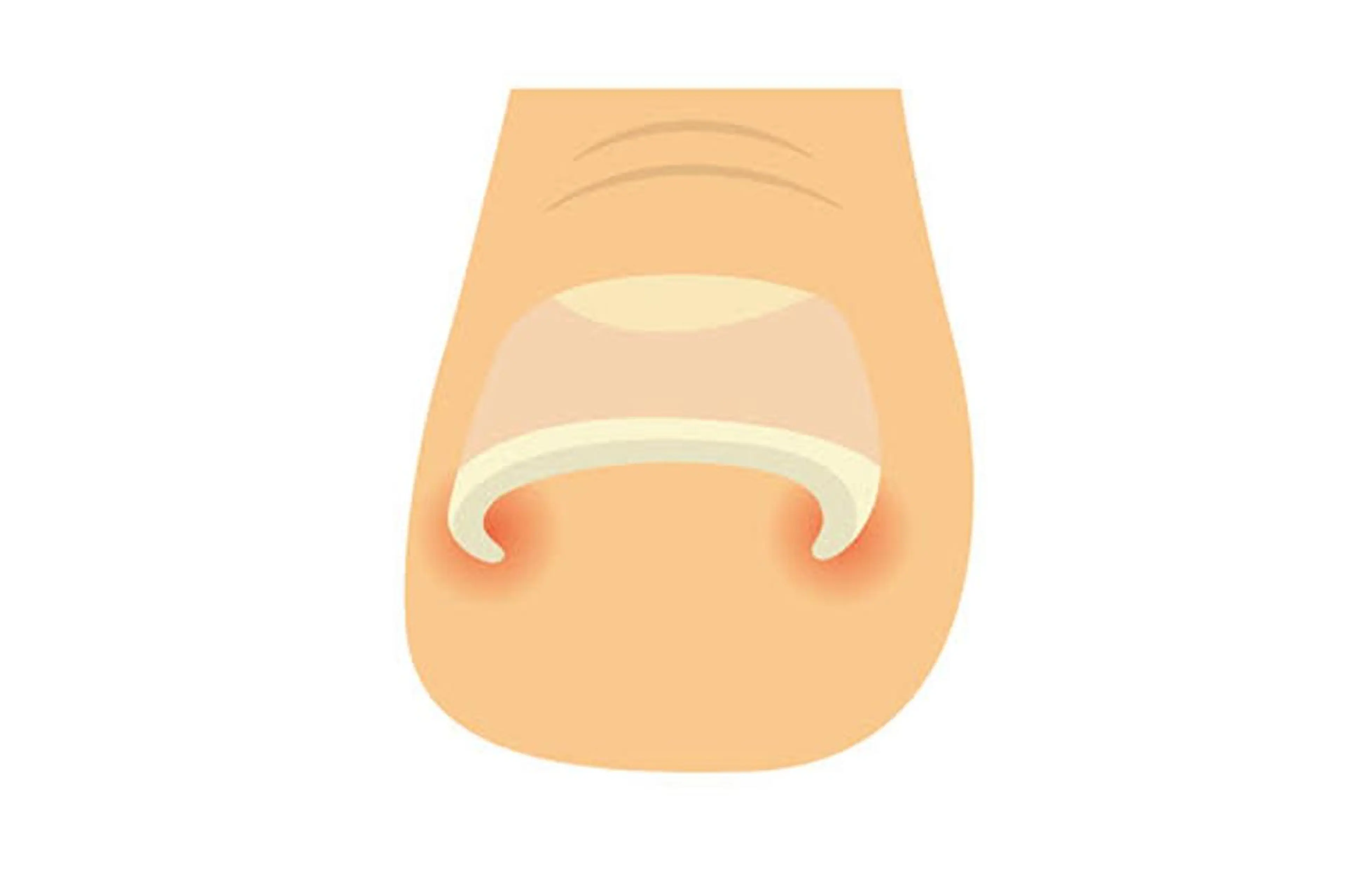 【フット】巻き爪アクリル補正1本★ネイルのついでにOK！ご予約時にメッセージにて巻き爪補正希望とお伝えくださいの写真