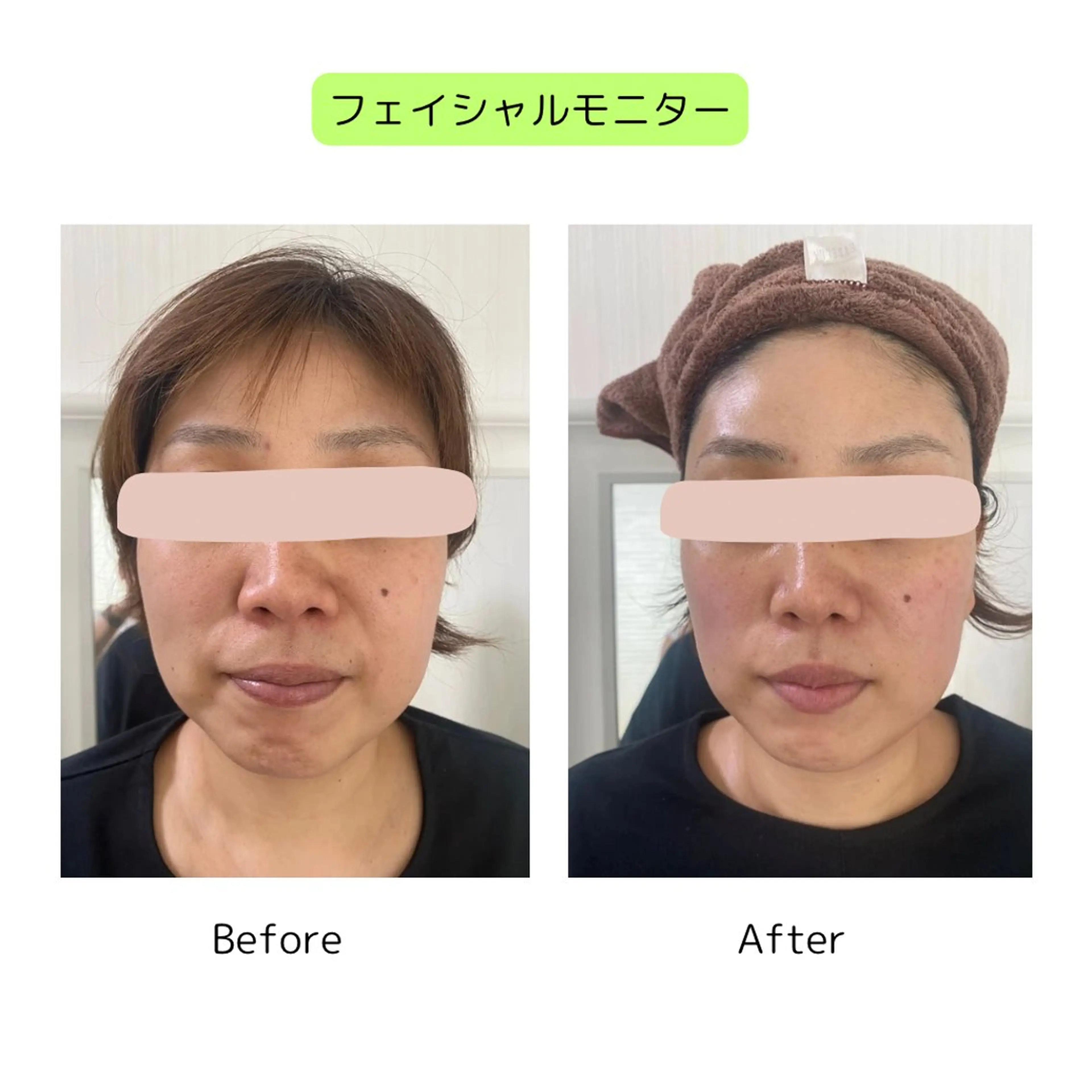 植物性ミネラルで整える小顔フェイシャル:モニター（お写真、アンケートのご協力をお願いいただける方限定）の写真