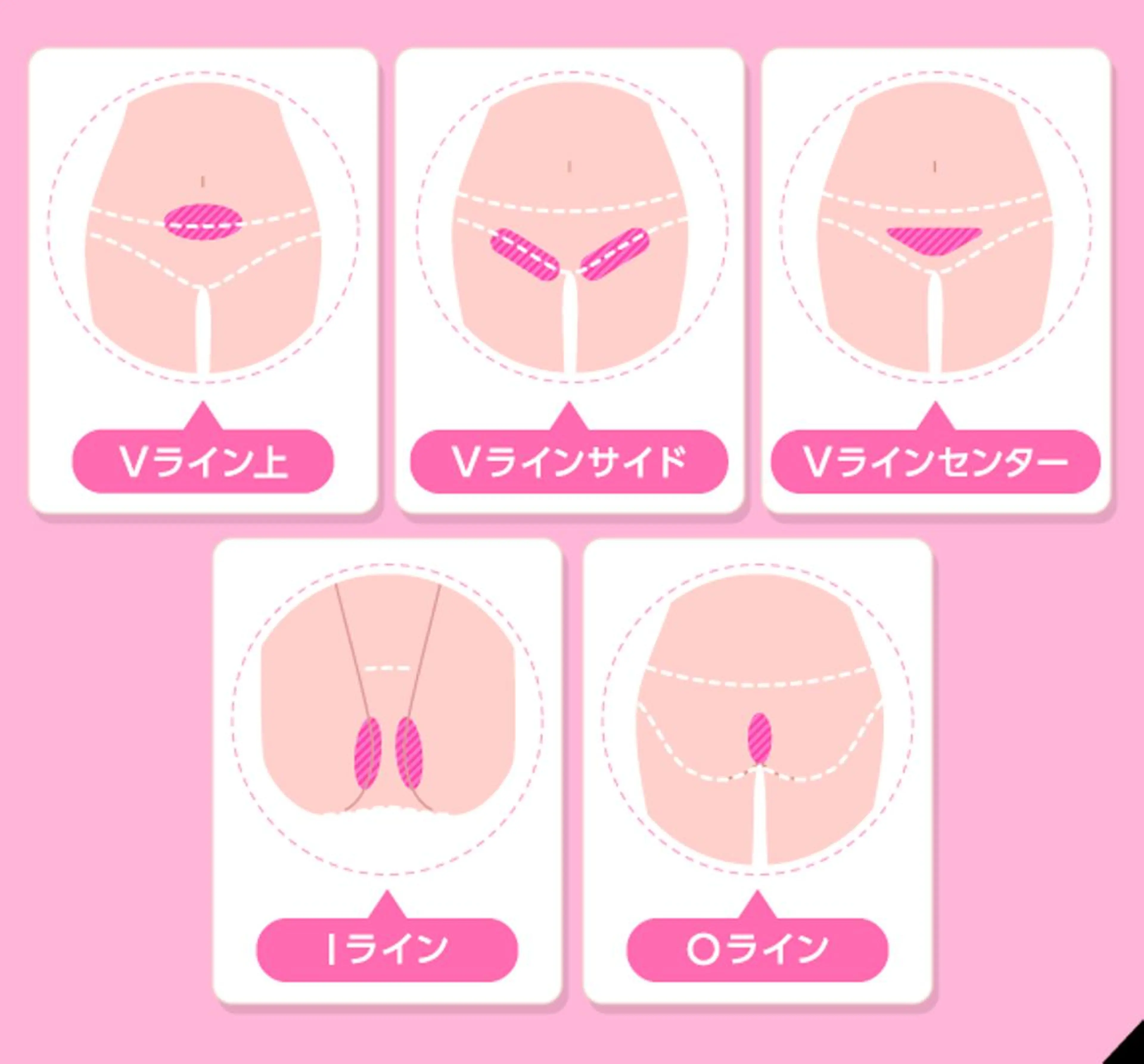 【🌺おすすめ🌺】VIO美肌光脱毛✨最新機器痛みなし◎剃毛サービス👧の写真