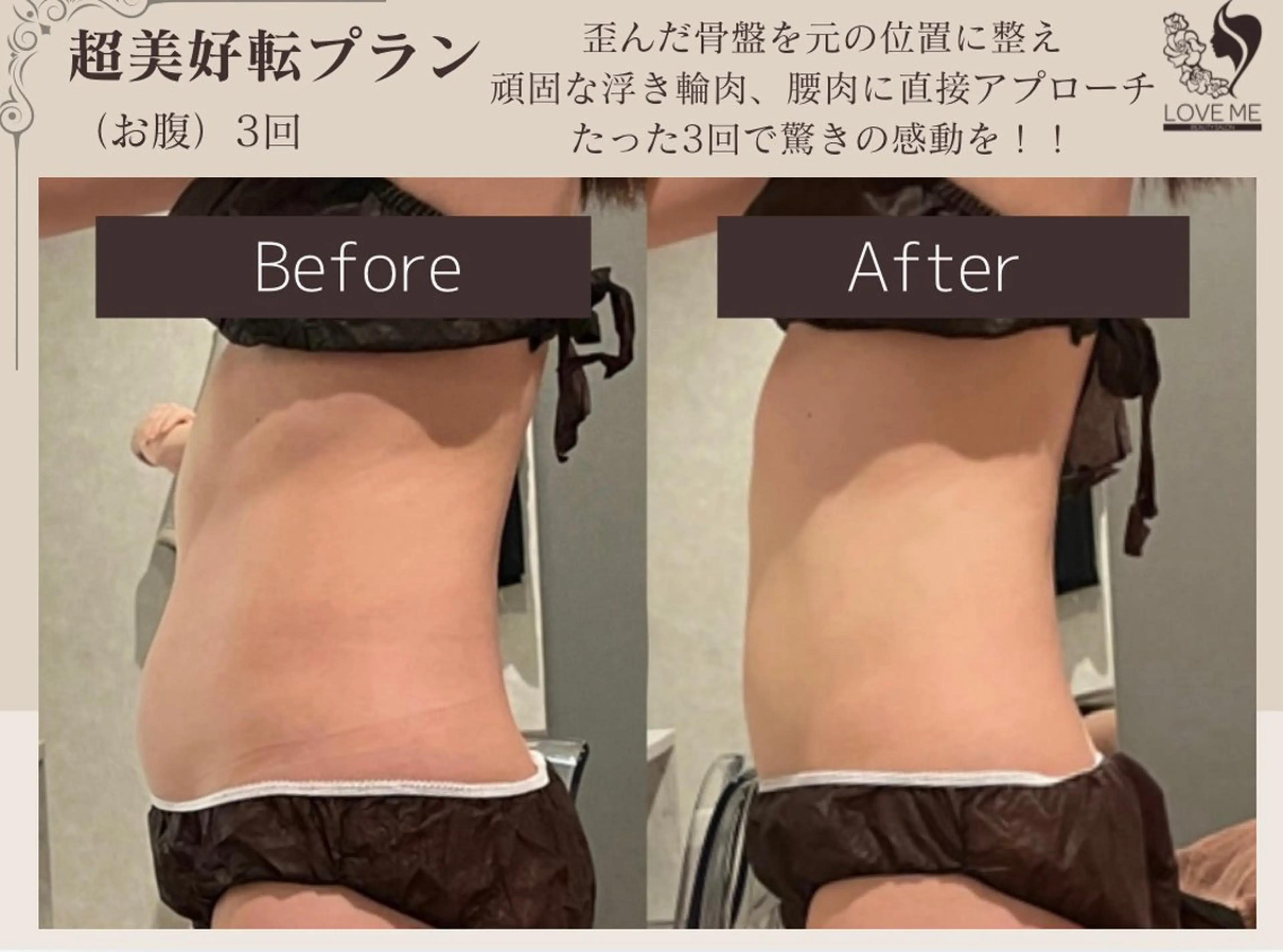 《1部位集中痩せ》骨盤矯正＋蓄熱式超音波※無制限ショット数&EMSの写真