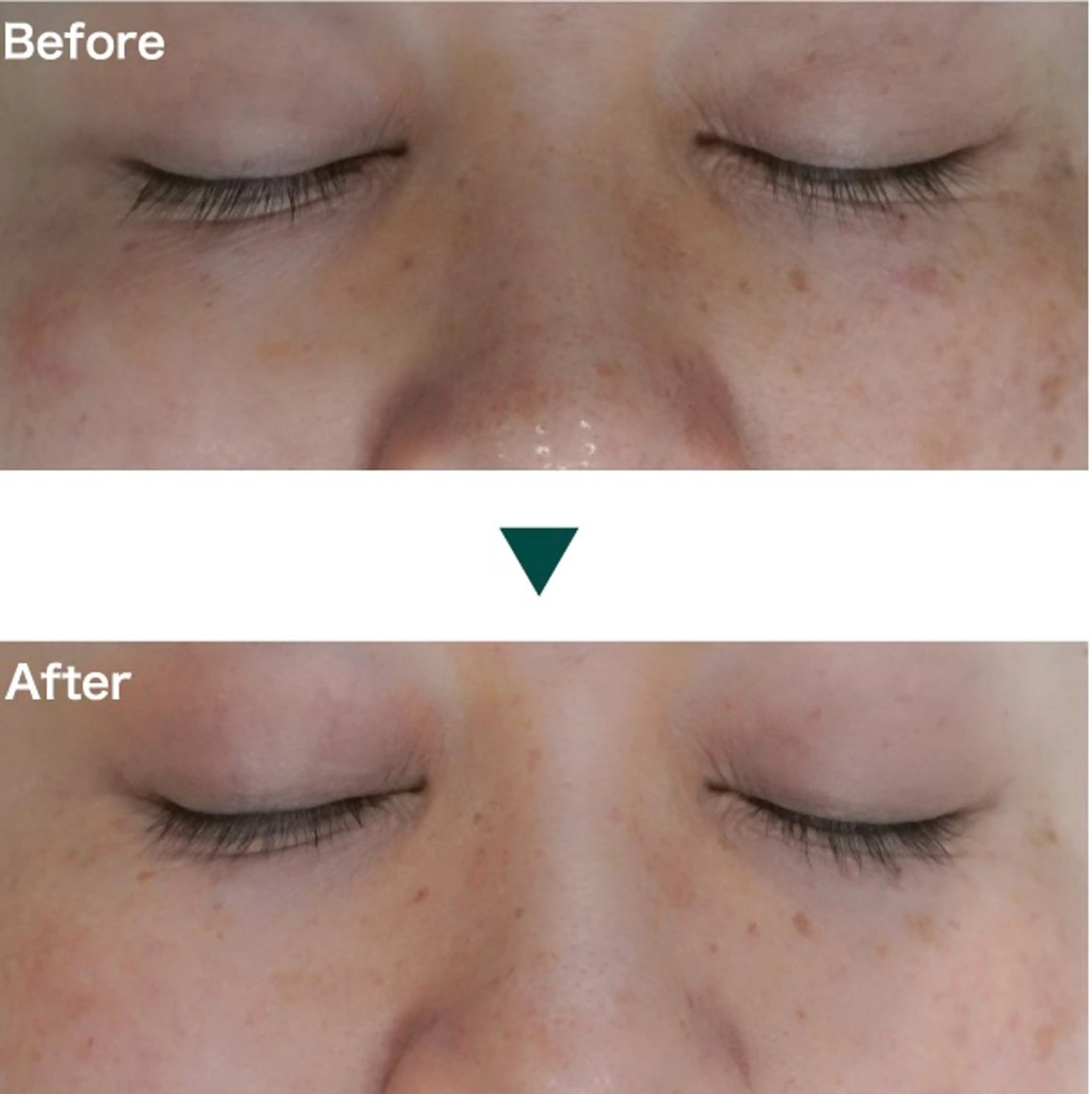 【ニキビ・ニキビ跡】強炭酸ピーリング 50分の写真