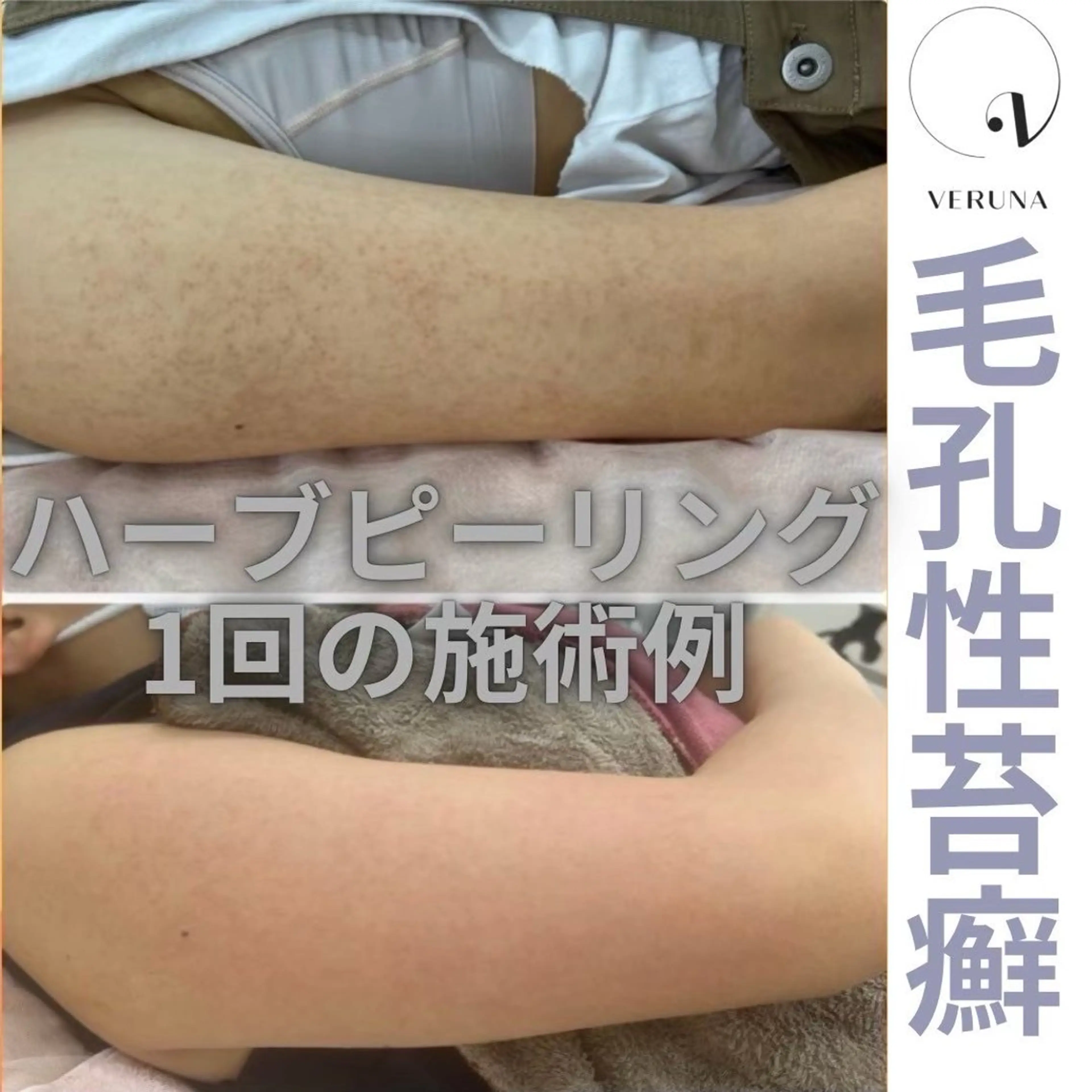 二の腕のブツブツに！剥離ありハーブピーリング🌿の写真