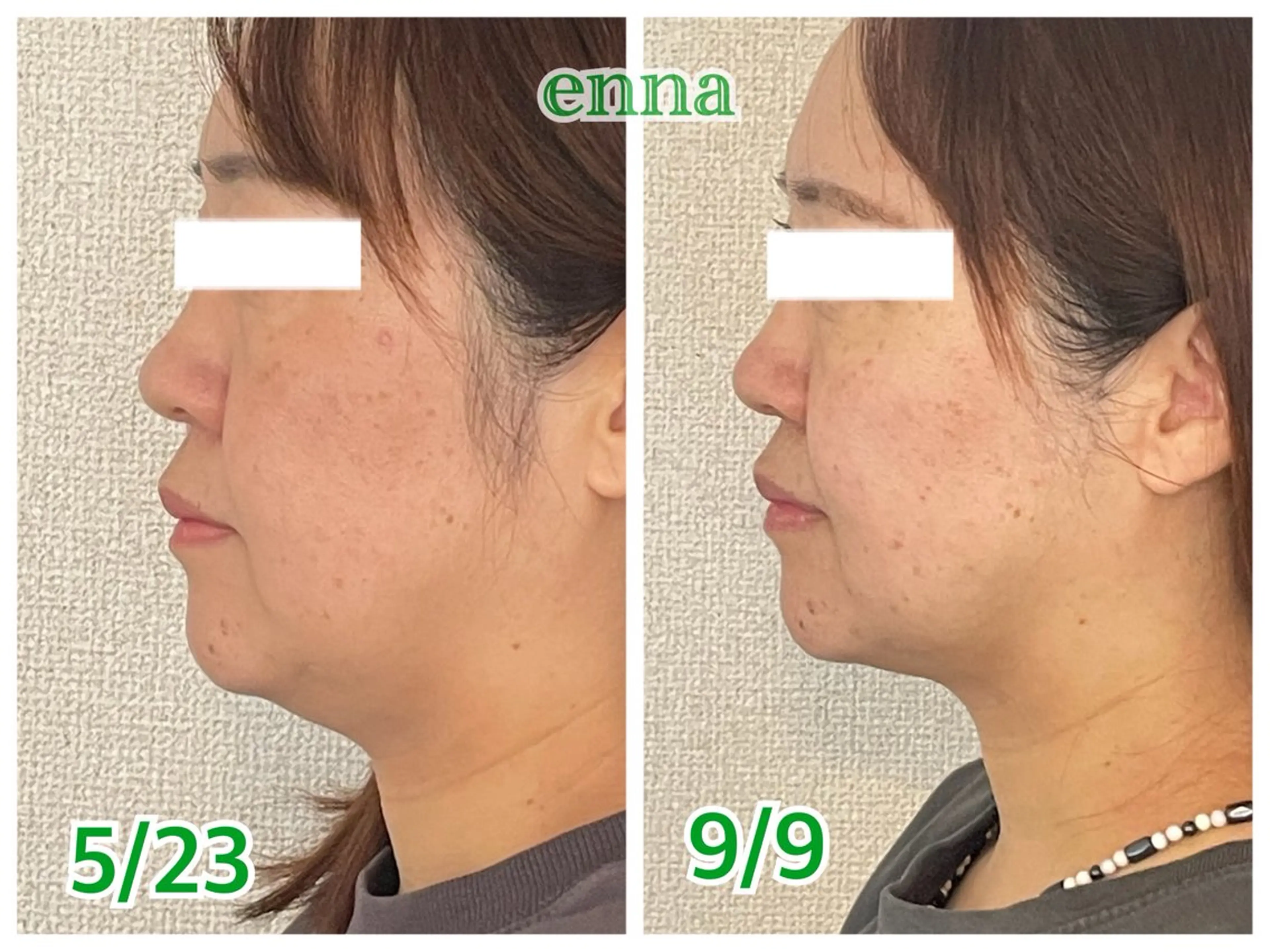 【フェイスライン集中ケア】首との境目のもたつきにお悩みの方への写真