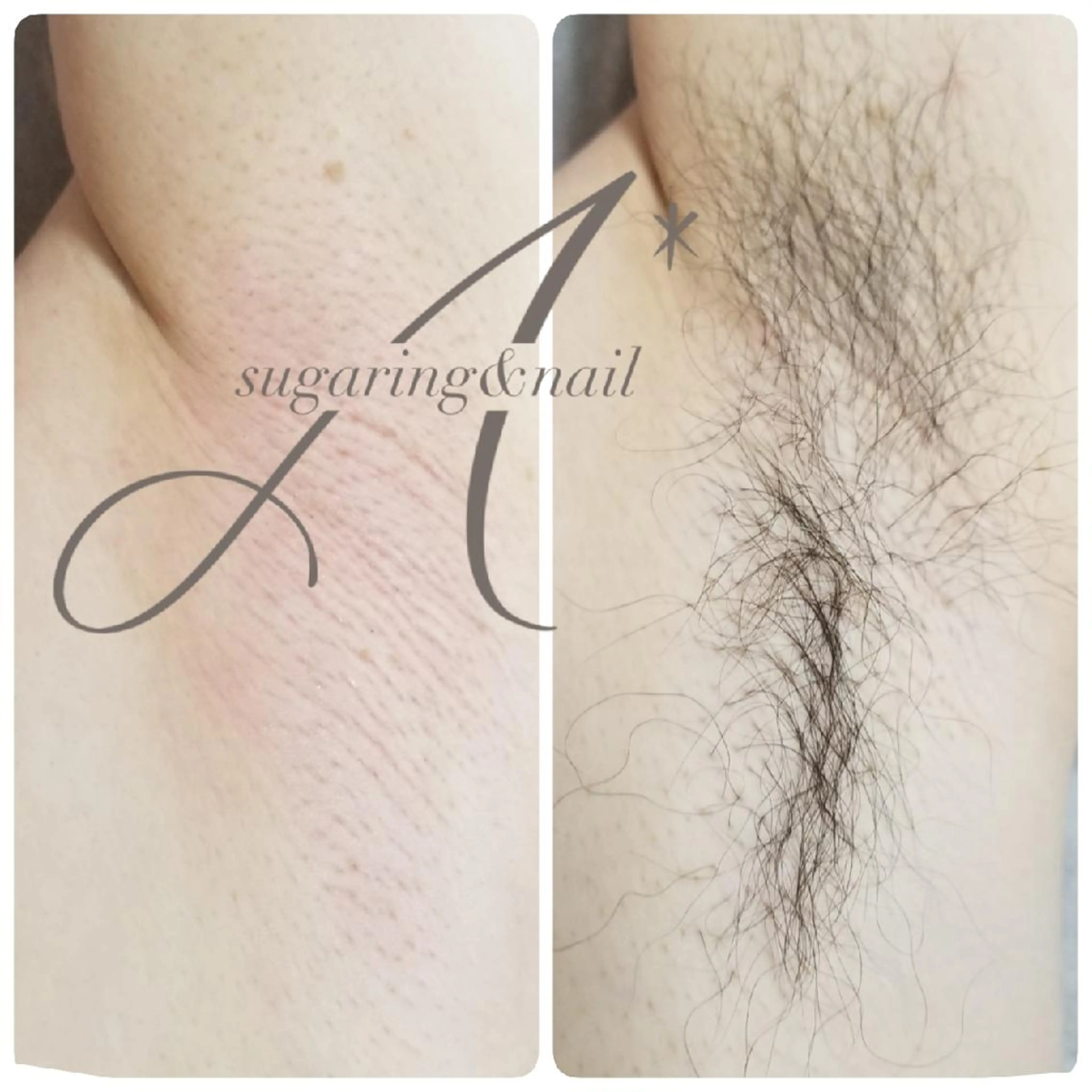 A*[エースター] シュガーリング🍋のエステ・リラクイメージ