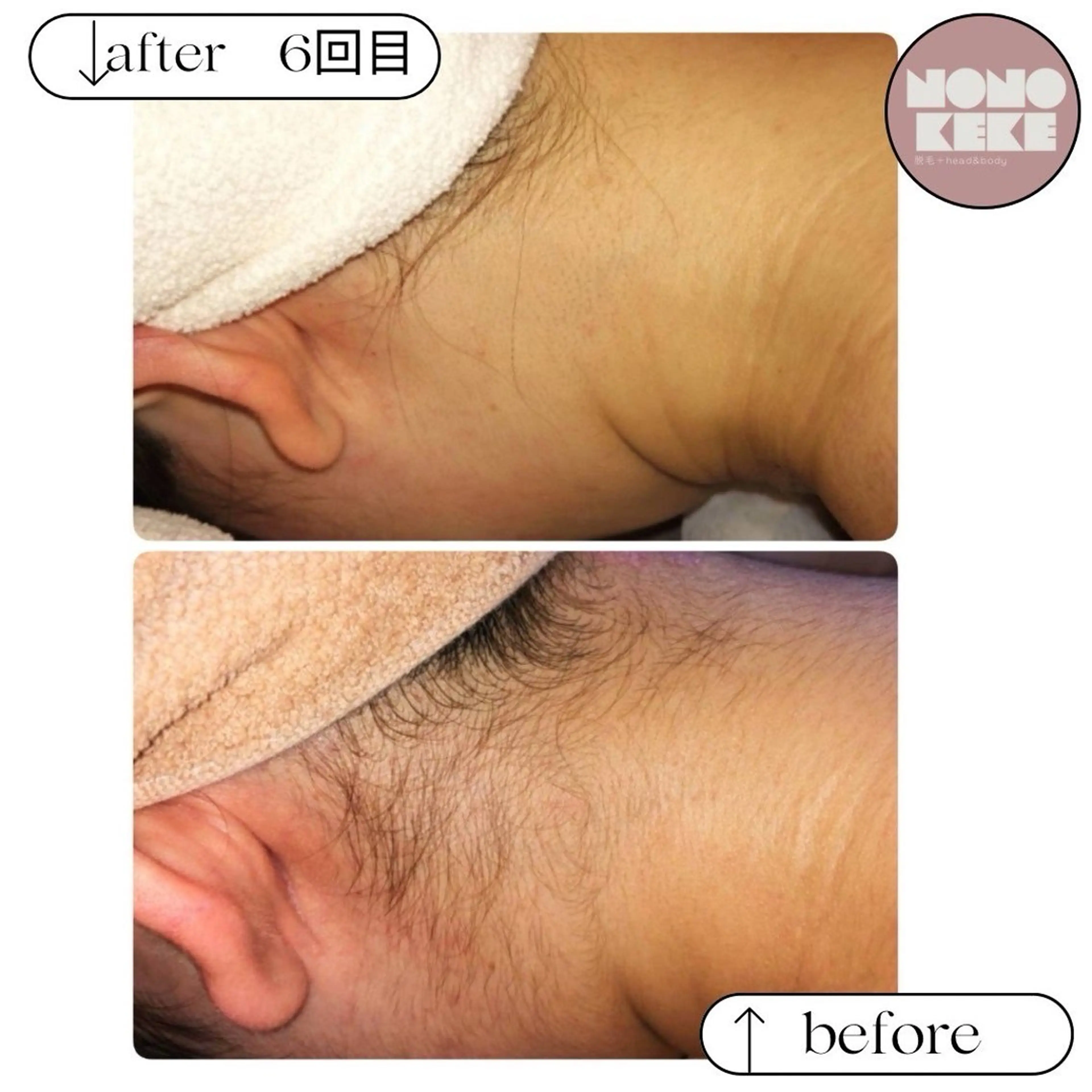 《レディース初回》うなじ脱毛◆首元スッキリ！魅せる襟足＋うなじの写真