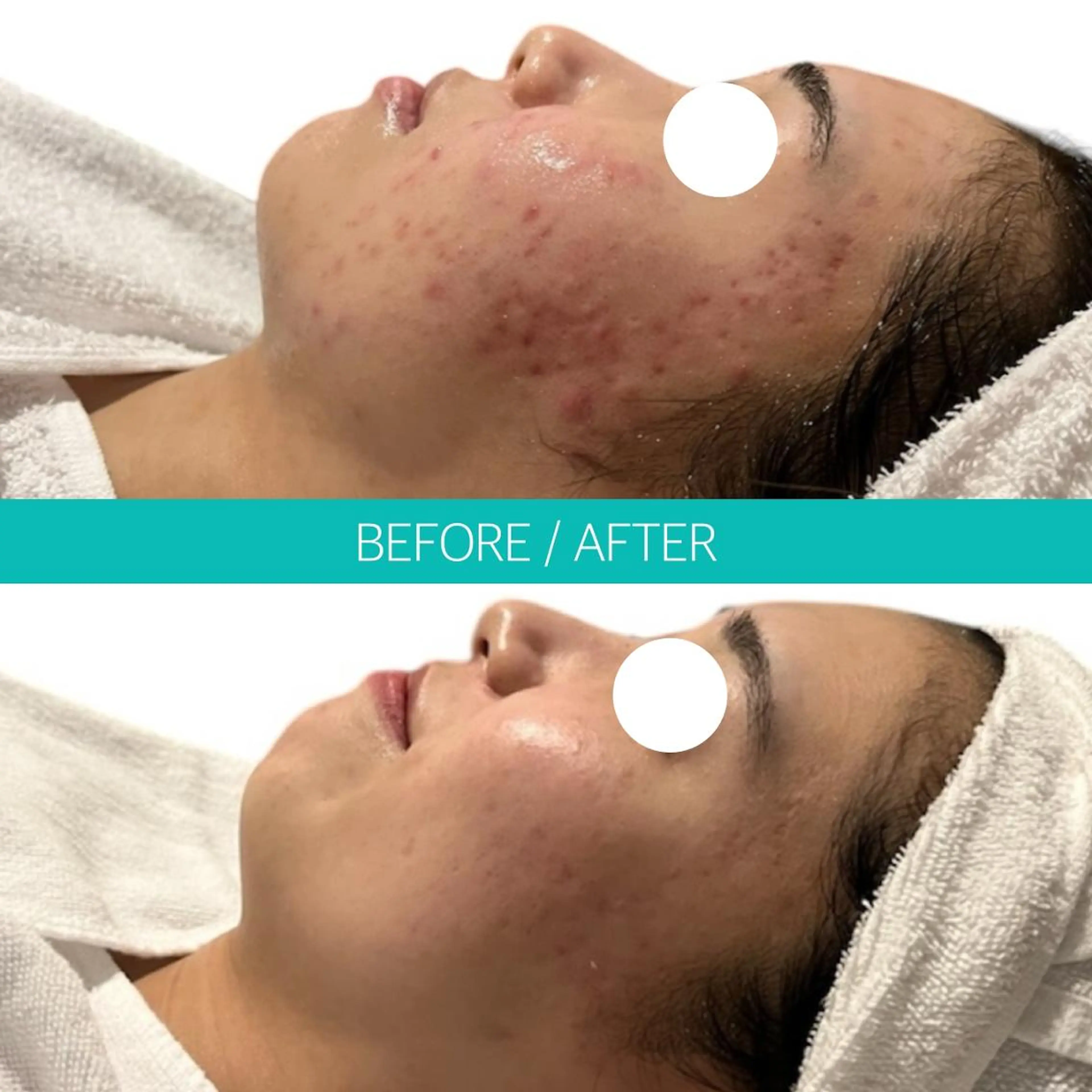 【徹底ニキビケア✨】結果を出したい方へ!フォトRF肌質改善・ニキビ・跡解消 ¥3,980の写真