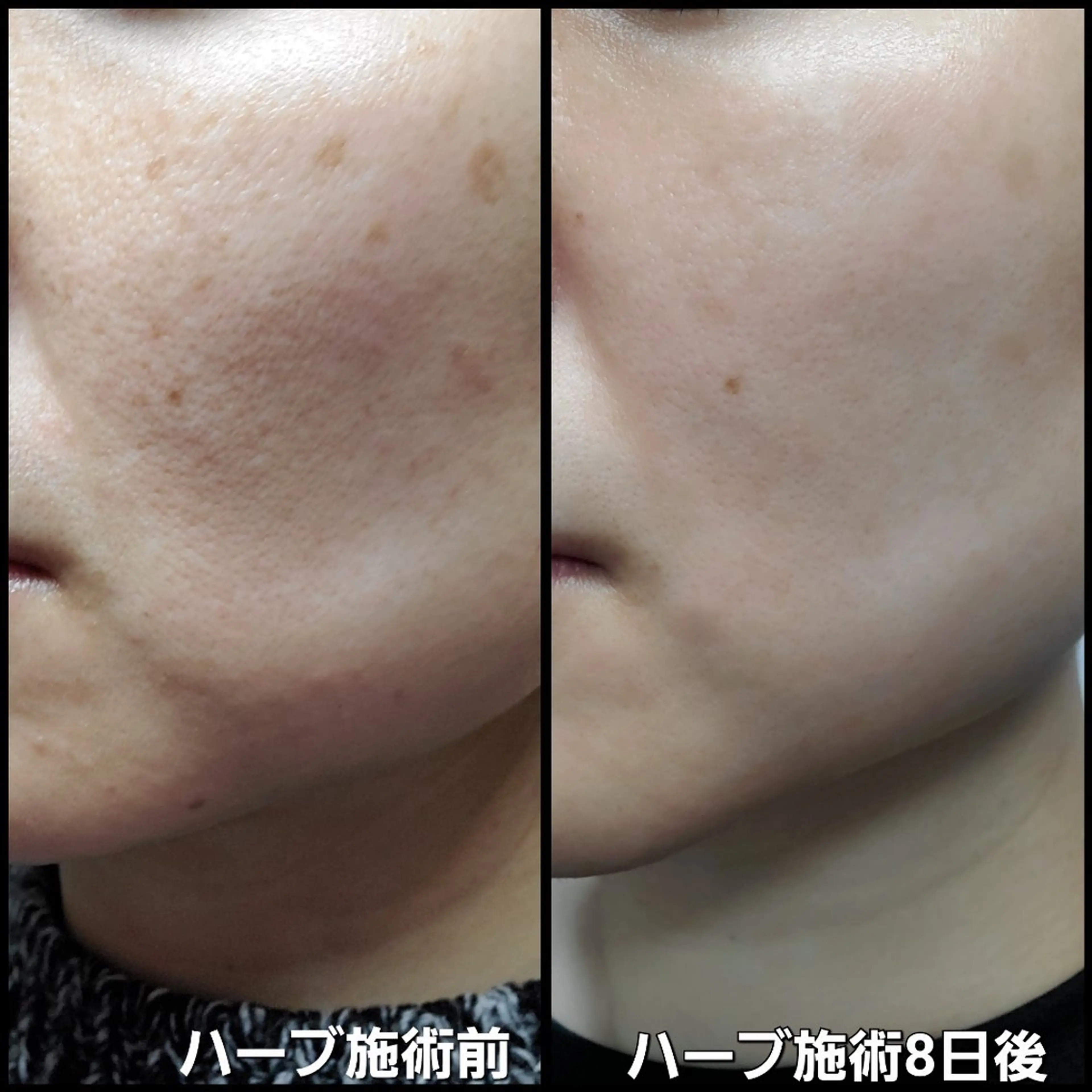 【肌荒れ/ニキビが気になる方へ】美肌を土台から育てる!ハーブ+無料エステ付の写真