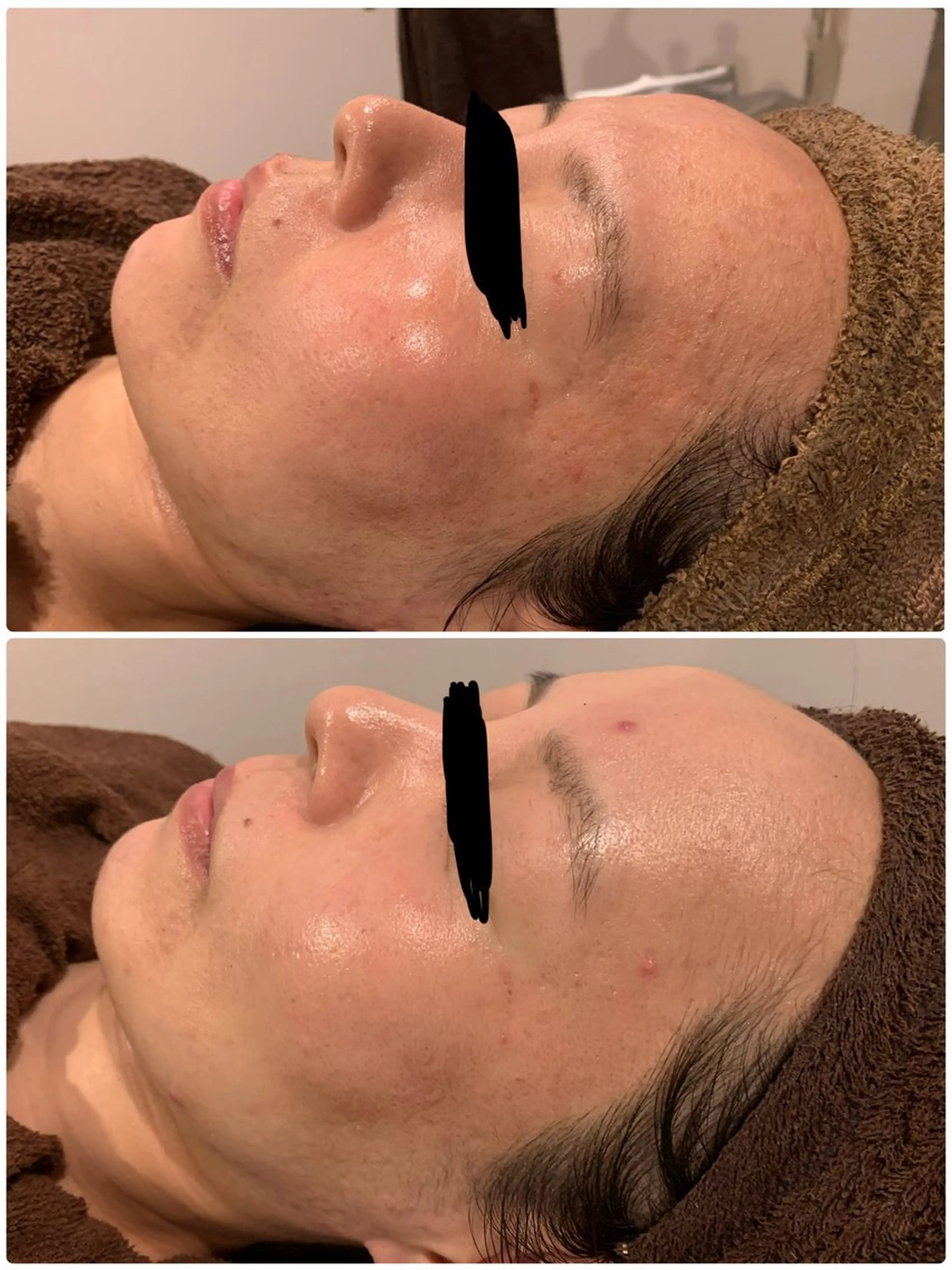 肌質改善ハーブピー リング🌿RINAのエステ・リラクイメージ